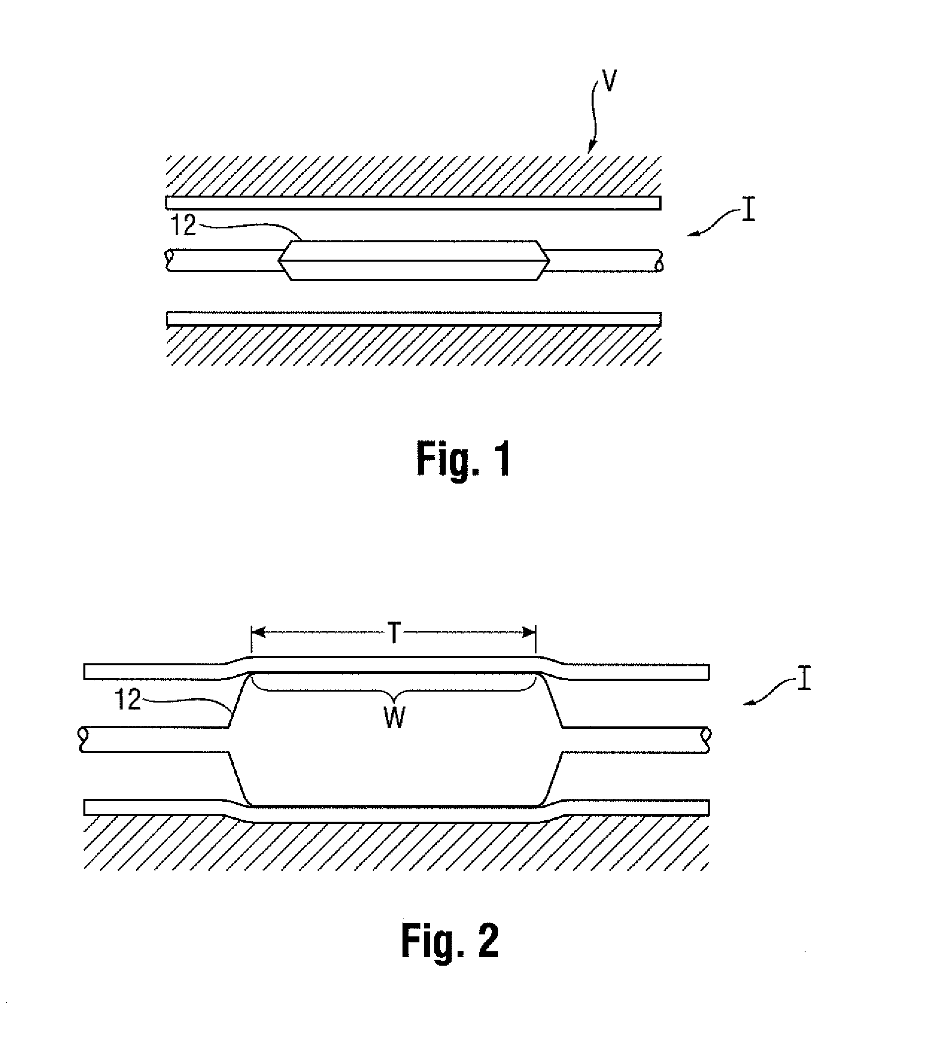 Parison for forming blow molded medical balloon with modified portion, medical balloon, and related methods