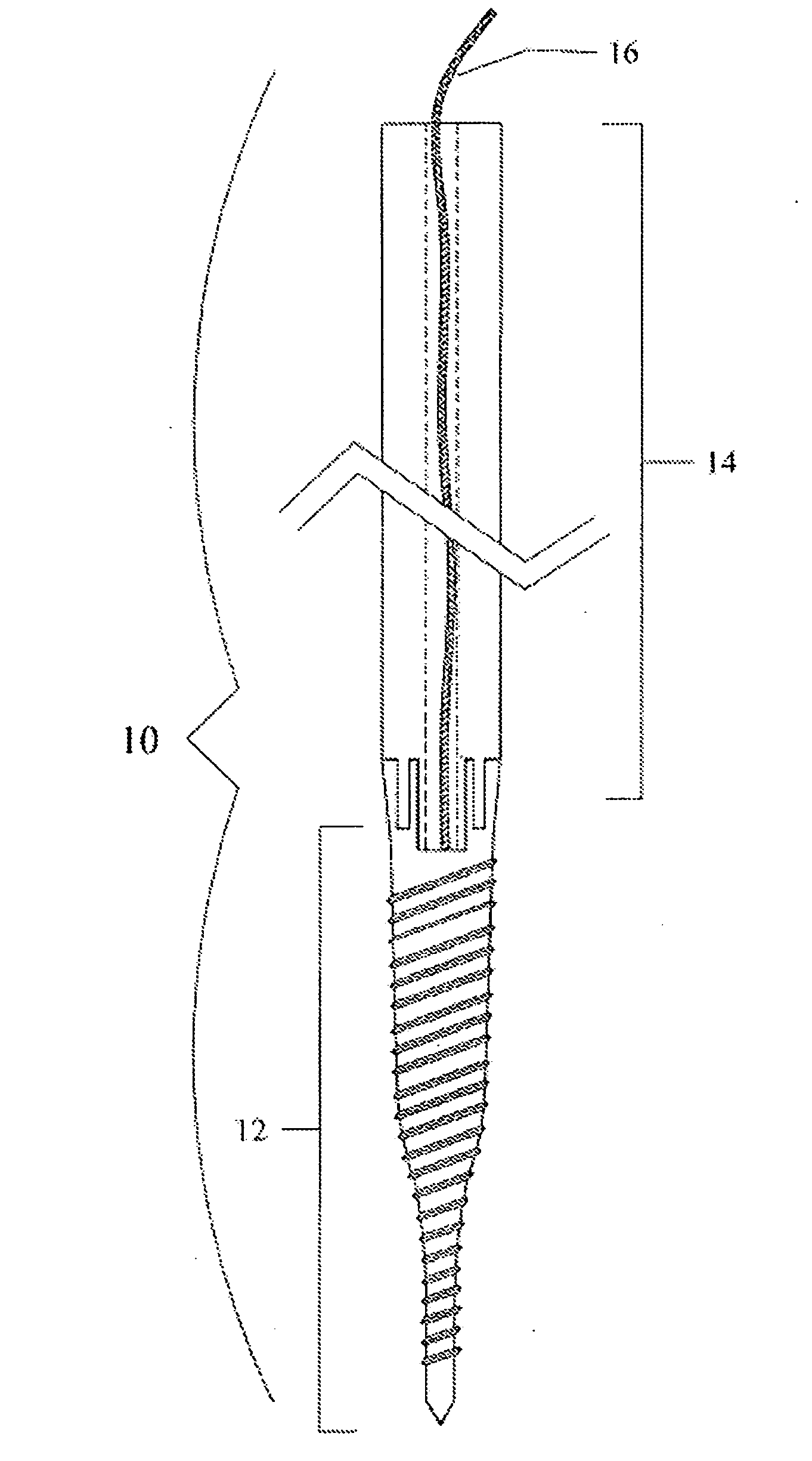 System and Method for Pedicle Screw Placement in Vertebral Alignment