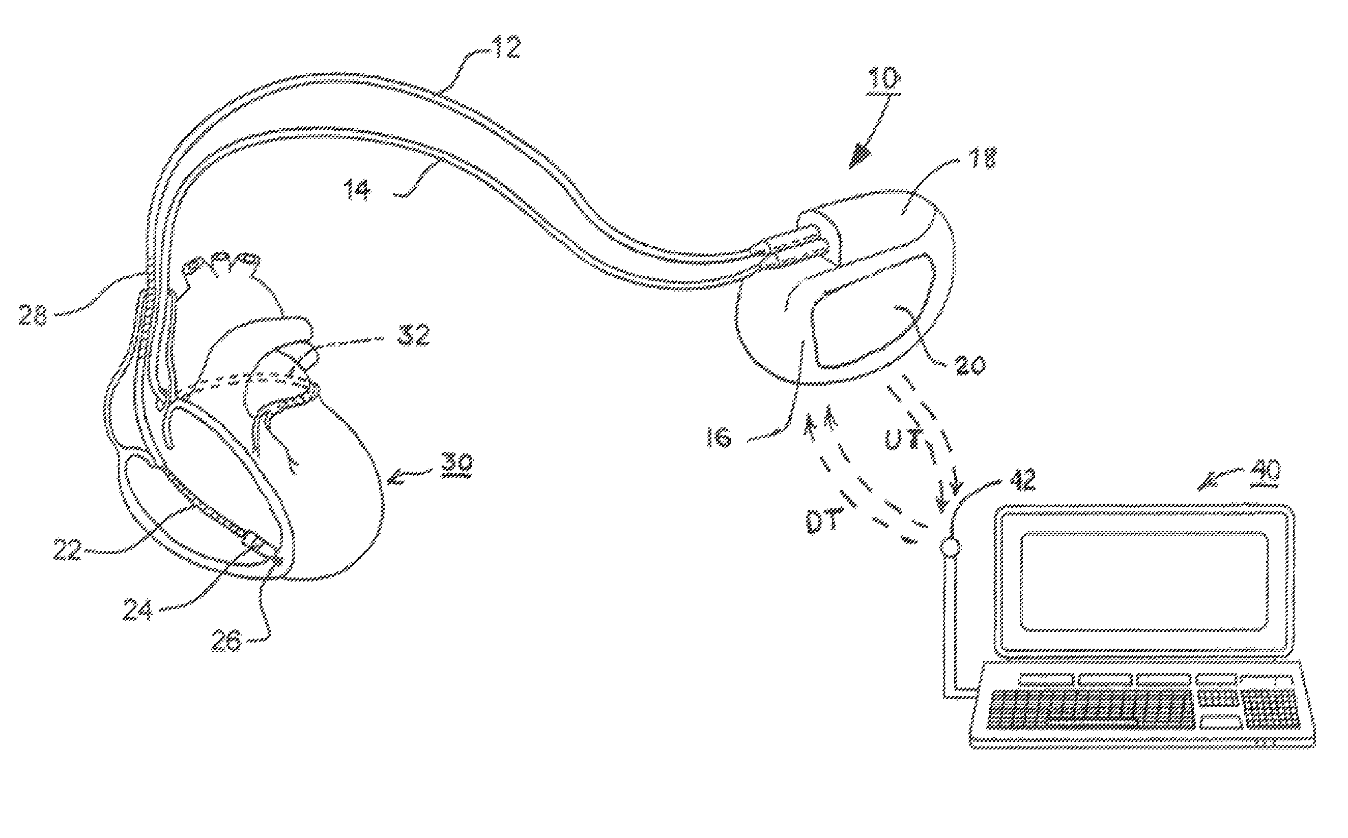 Methods and apparatus for discriminating polymorphic tachyarrhythmias from monomorphic tachyarrhythmias facilitating detection of fibrillation