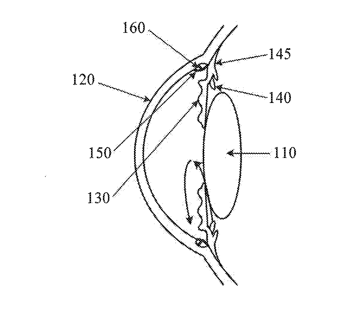 Trabecular meshwork stimulation device