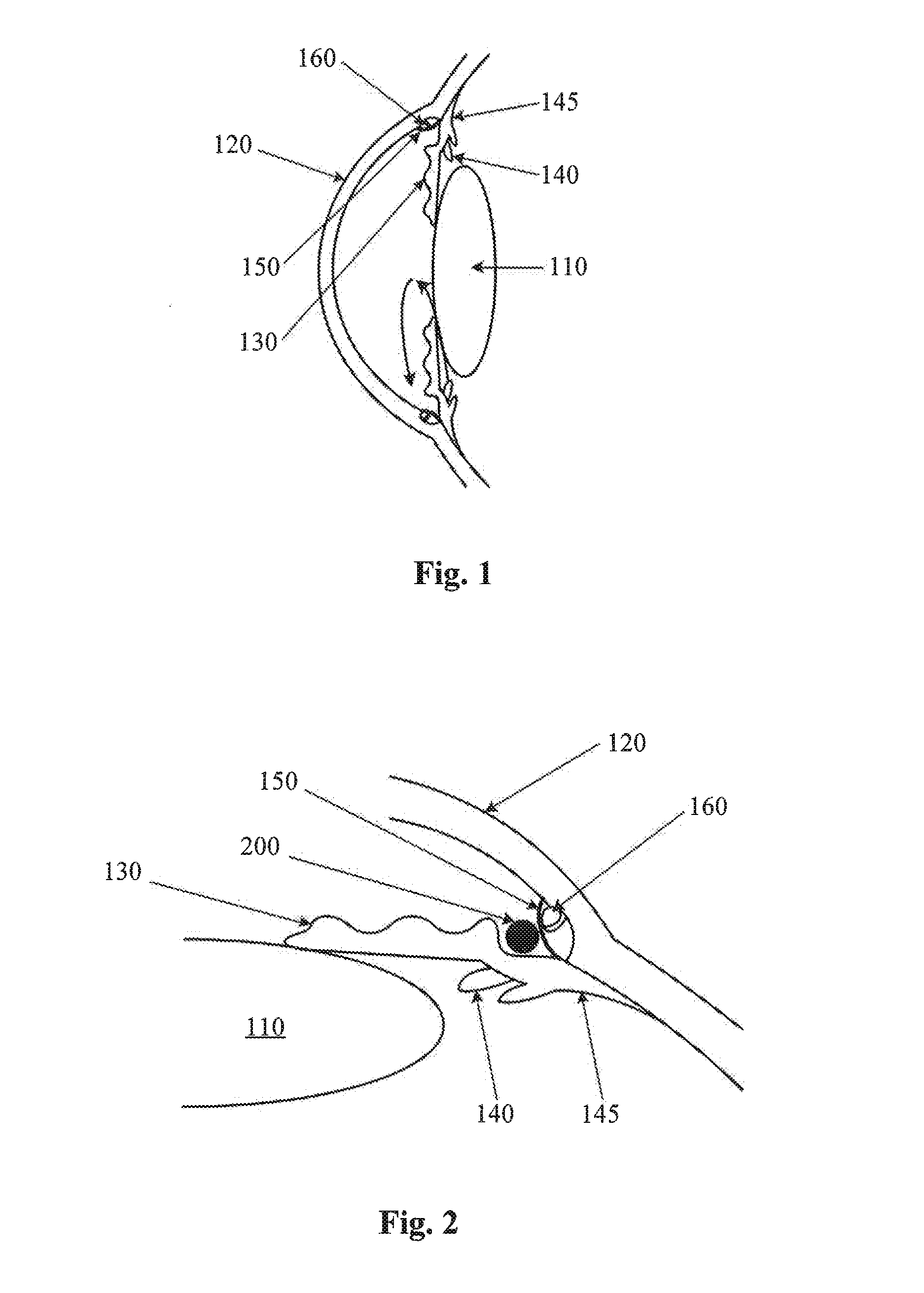 Trabecular meshwork stimulation device