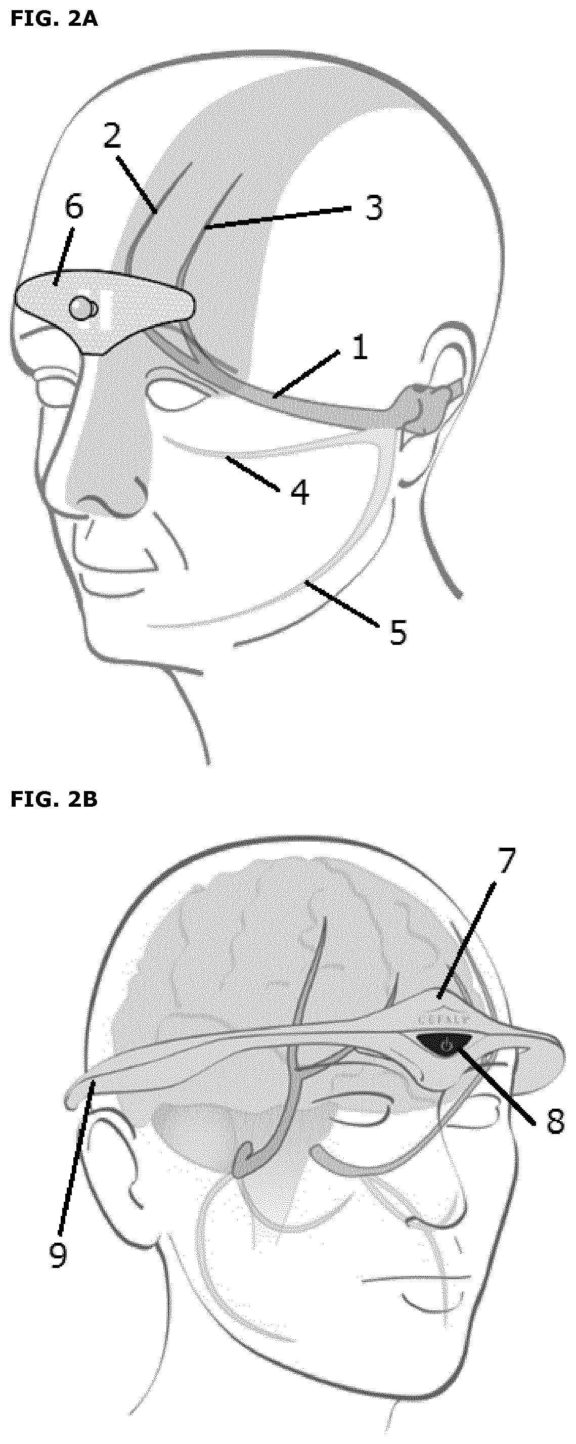 External Trigeminal Nerve Stimulation for the Acute Non-Invasive Treatment of Migraine Attacks