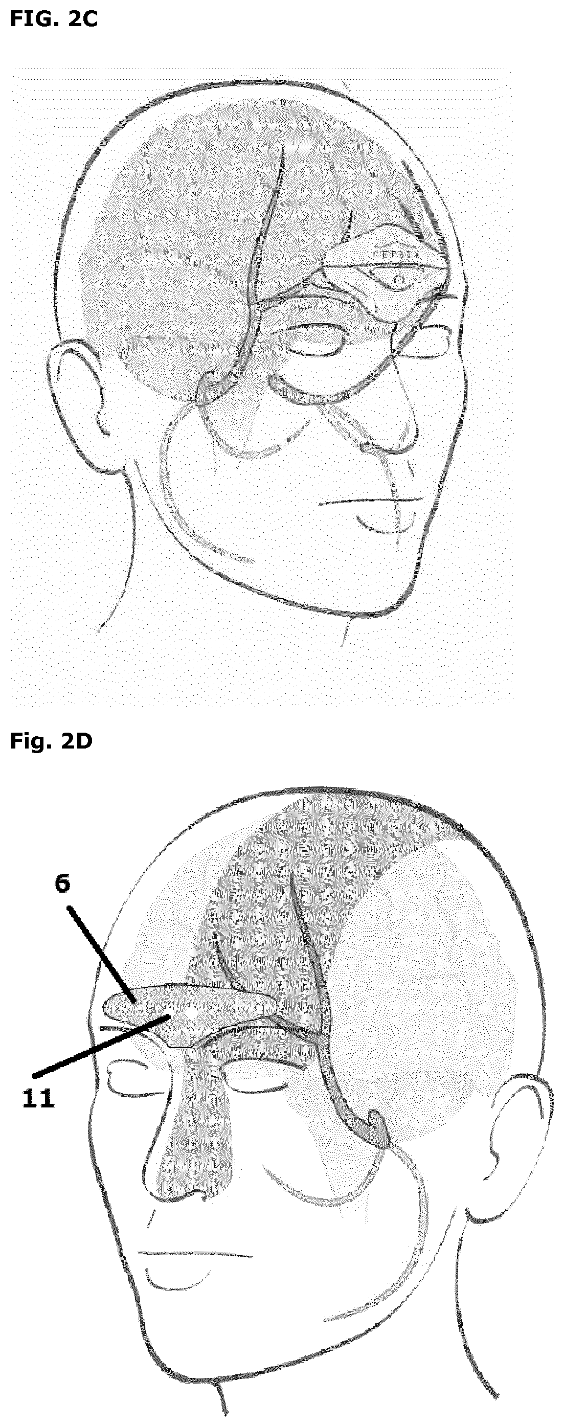 External Trigeminal Nerve Stimulation for the Acute Non-Invasive Treatment of Migraine Attacks