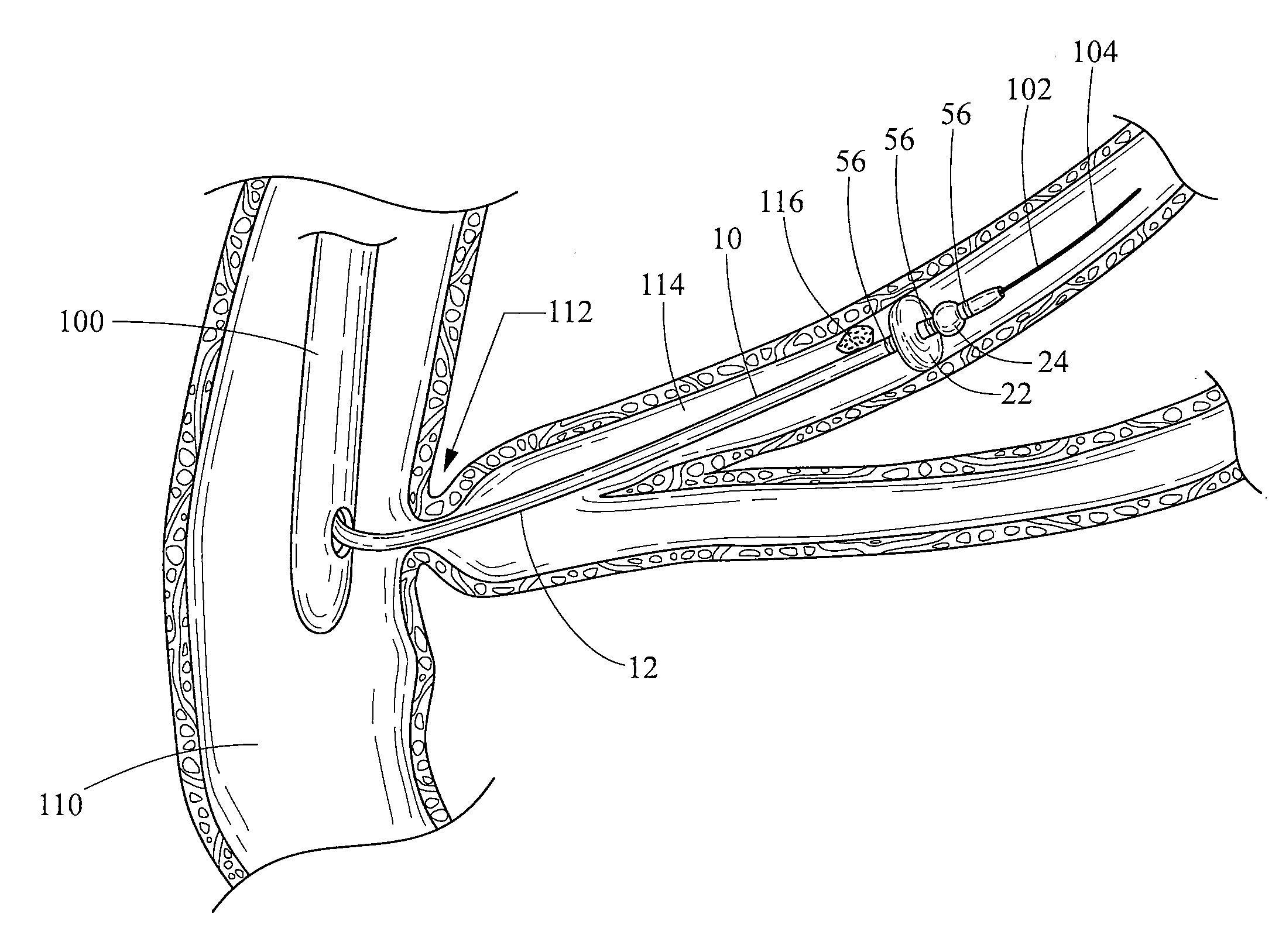 Two-part extraction balloon