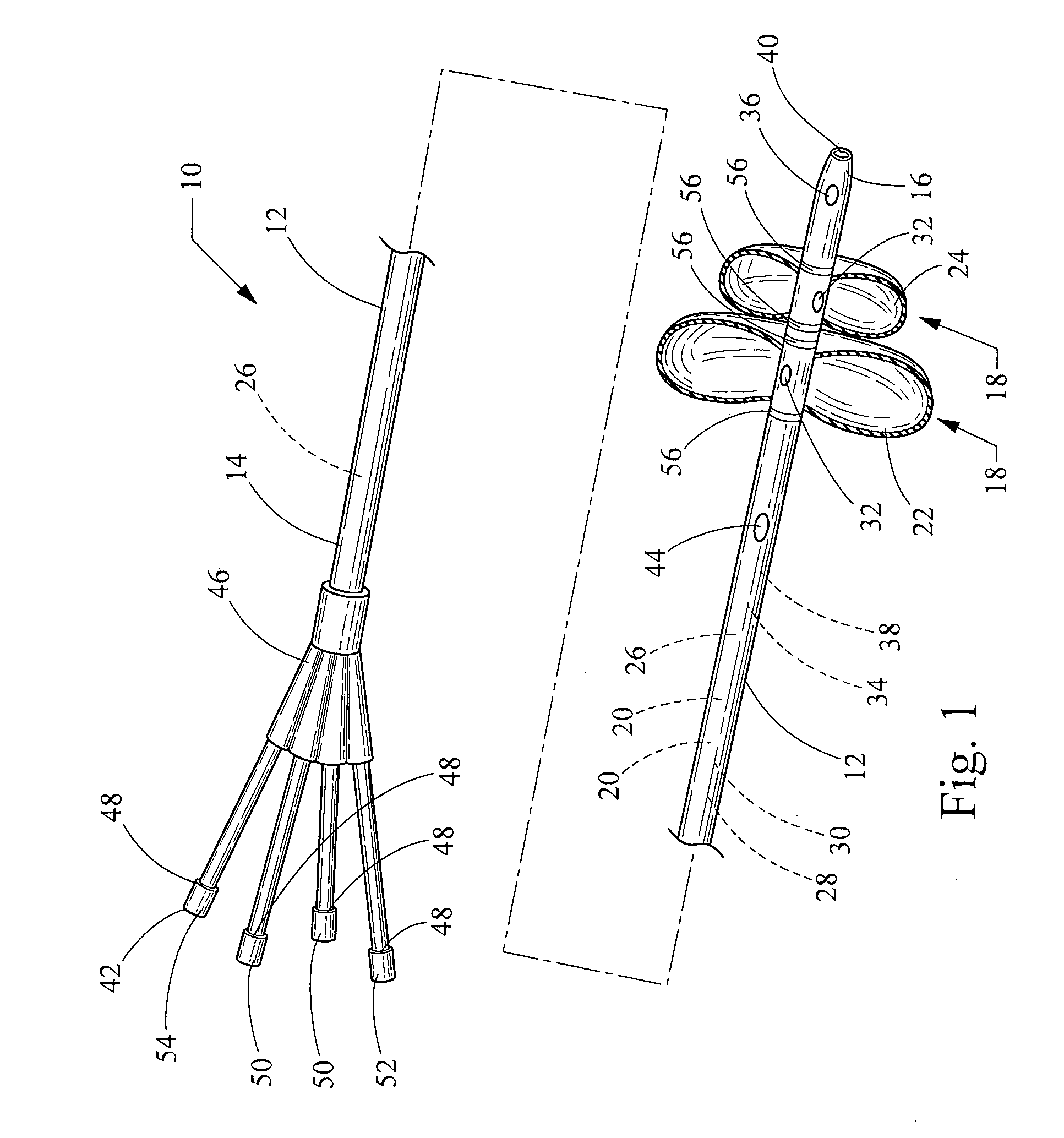 Two-part extraction balloon