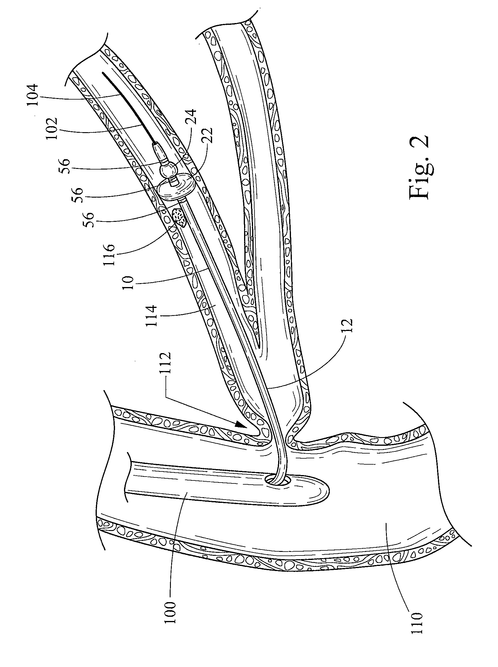 Two-part extraction balloon