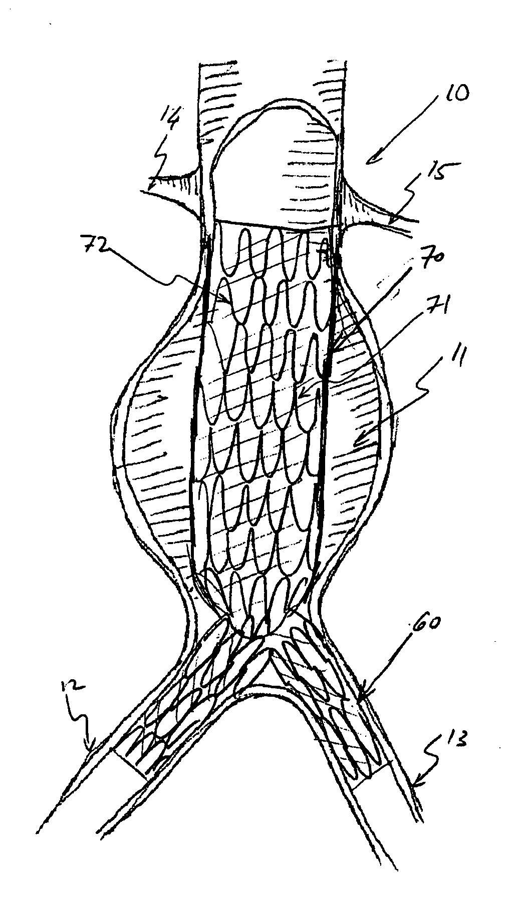 Multi-component expandable supportive bifurcated endoluminal grafts and methods for using same