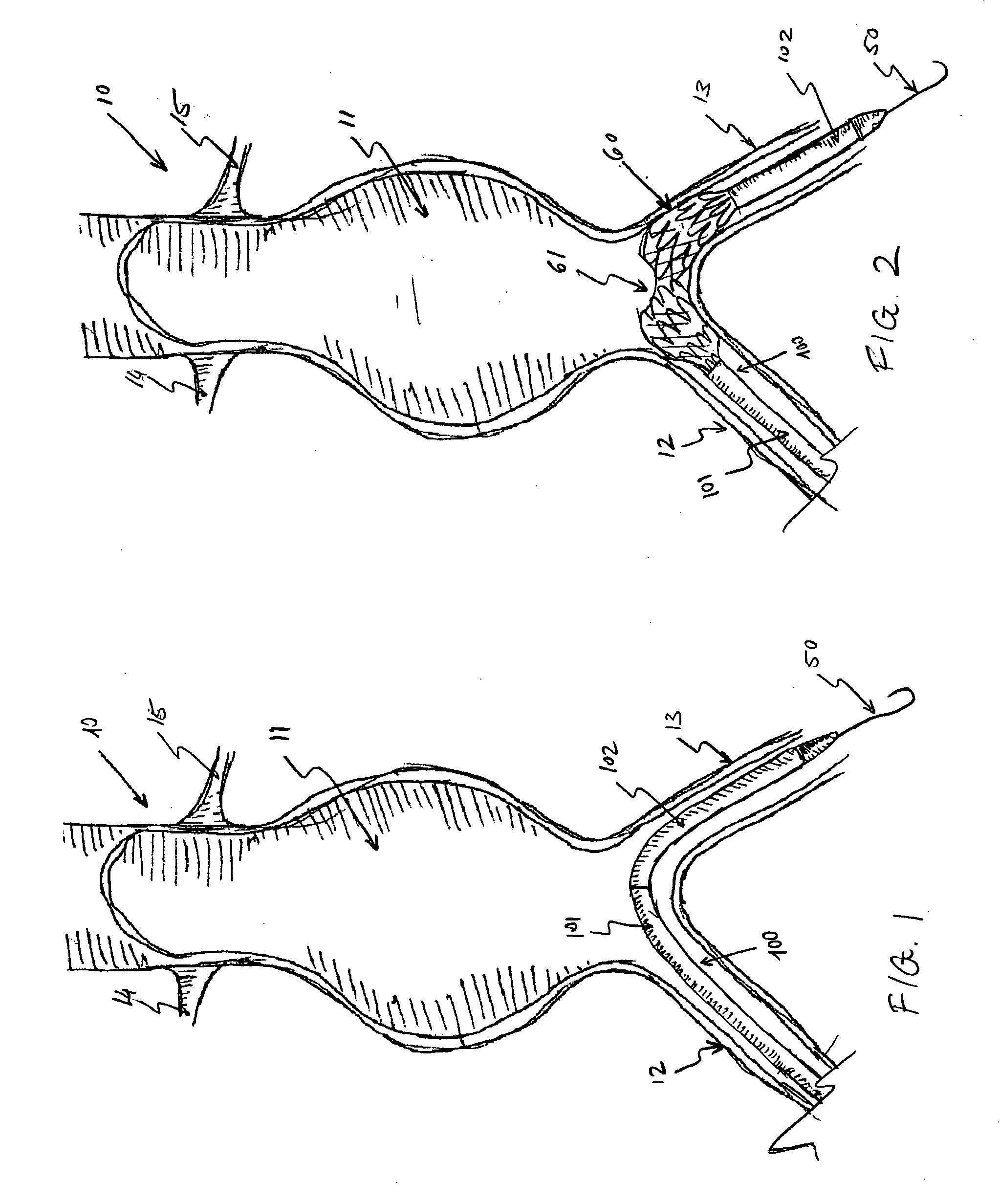 Multi-component expandable supportive bifurcated endoluminal grafts and methods for using same