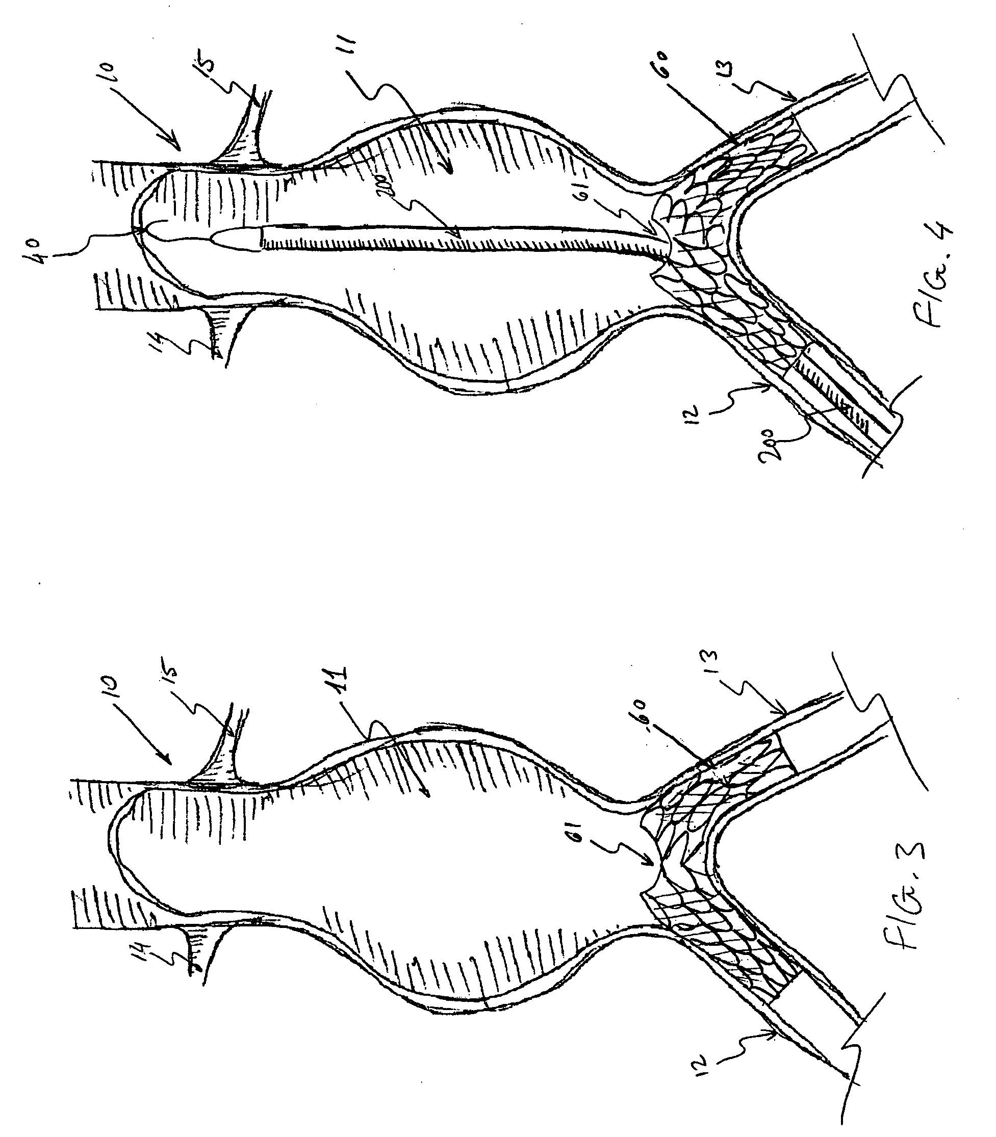 Multi-component expandable supportive bifurcated endoluminal grafts and methods for using same