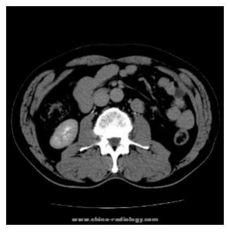 Medical image robust zero-watermark method based on Bandelet-DCT (Discrete Cosine Transform)