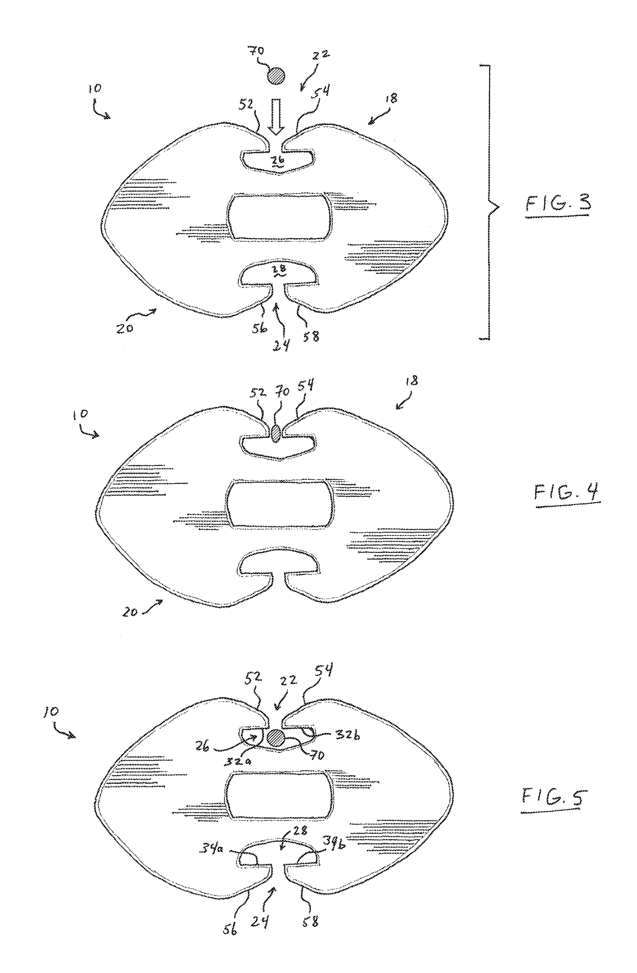 Suture button construct for surgical procedures