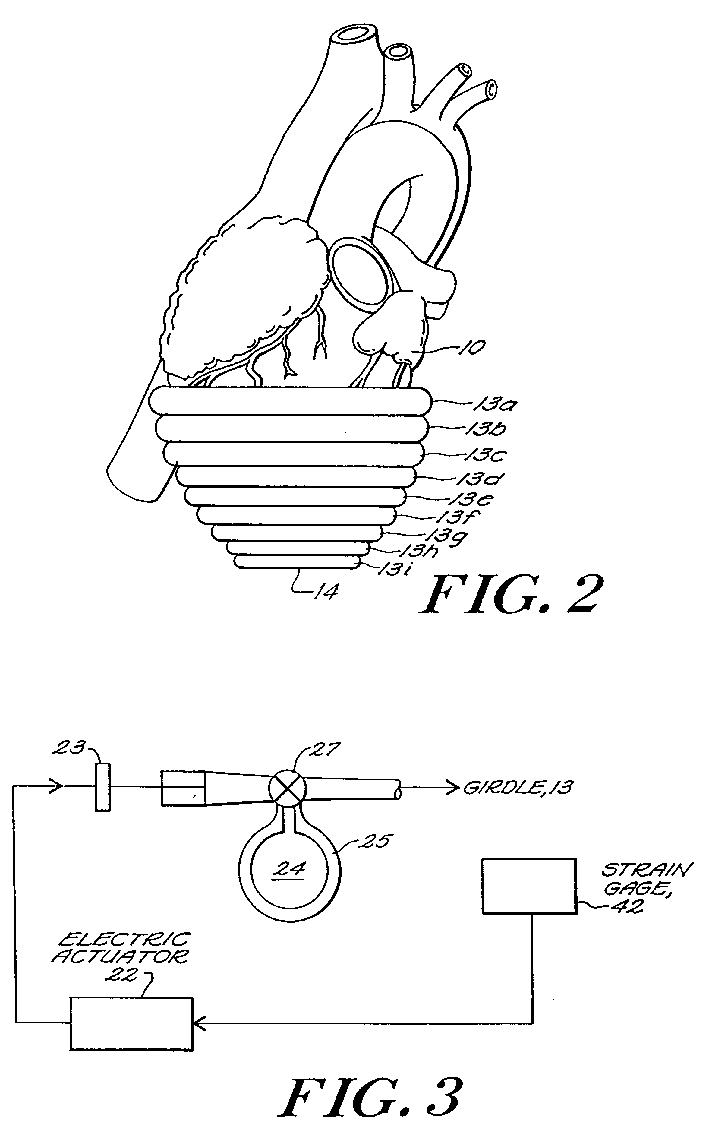 Passive girdle for heart ventricle for therapeutic aid to patients having ventricular dilatation