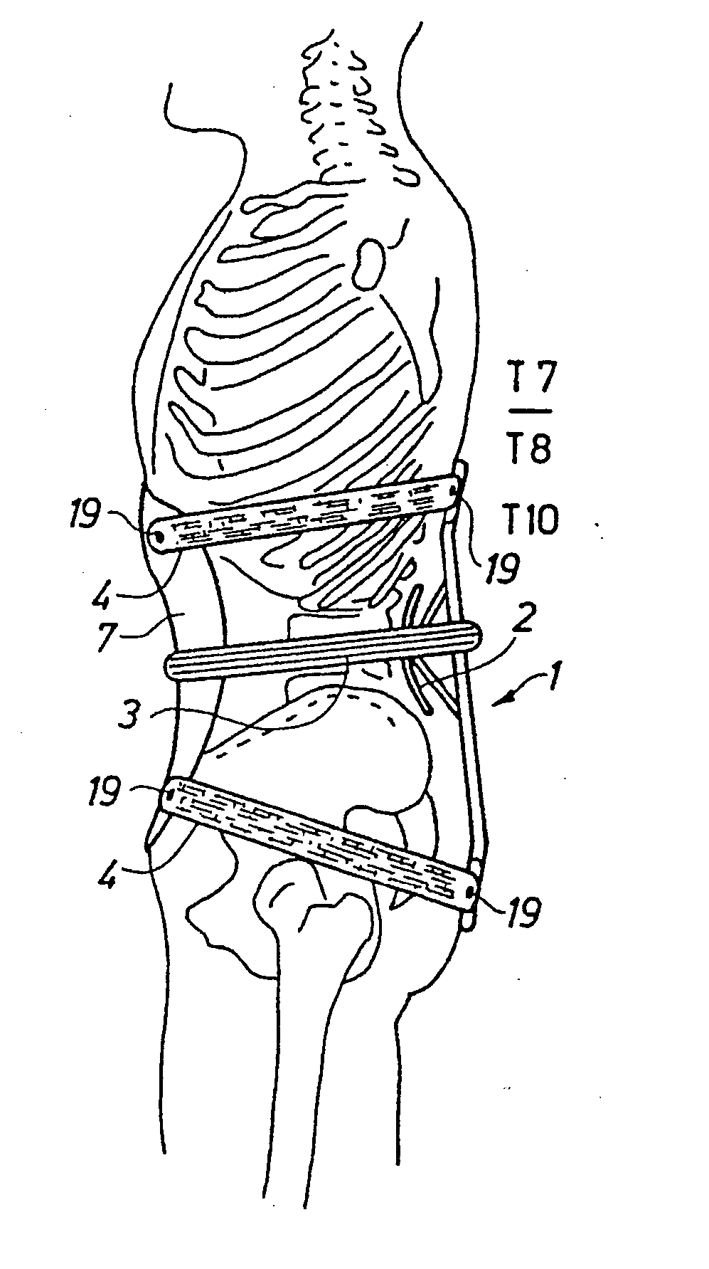 Adjustable spinal brace