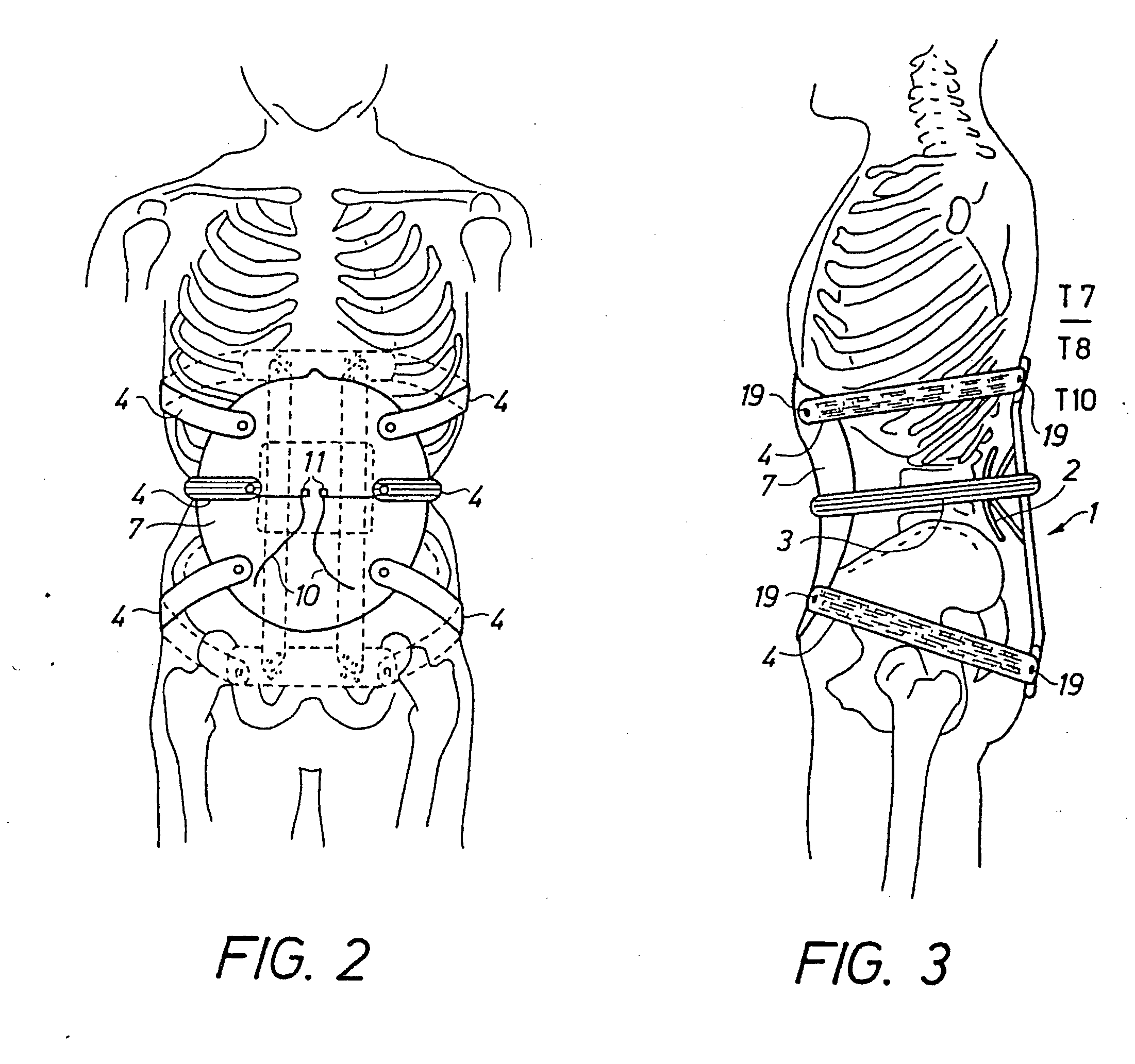 Adjustable spinal brace