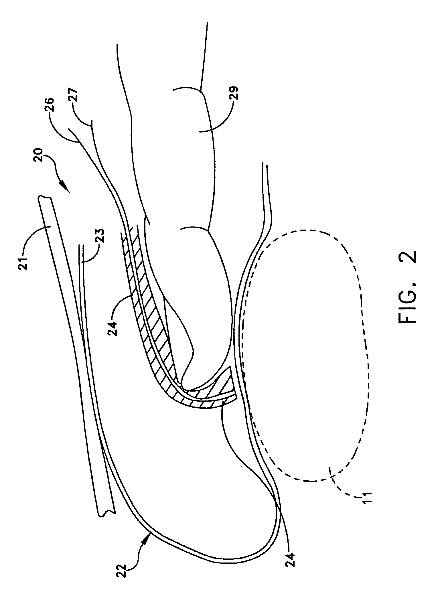 Apparatus and method for measuring the dimensions of the palpable surface of the prostate