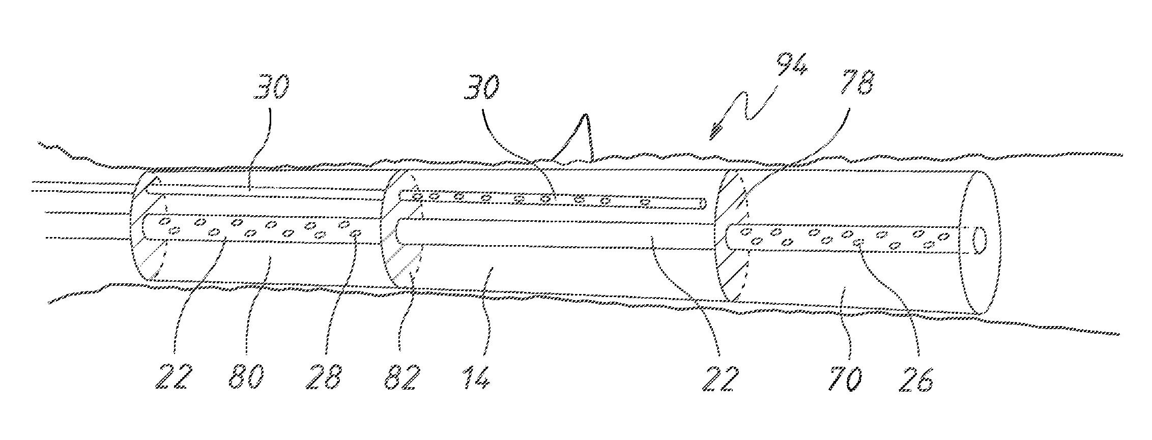 Endoluminal Vacuum Therapy Device