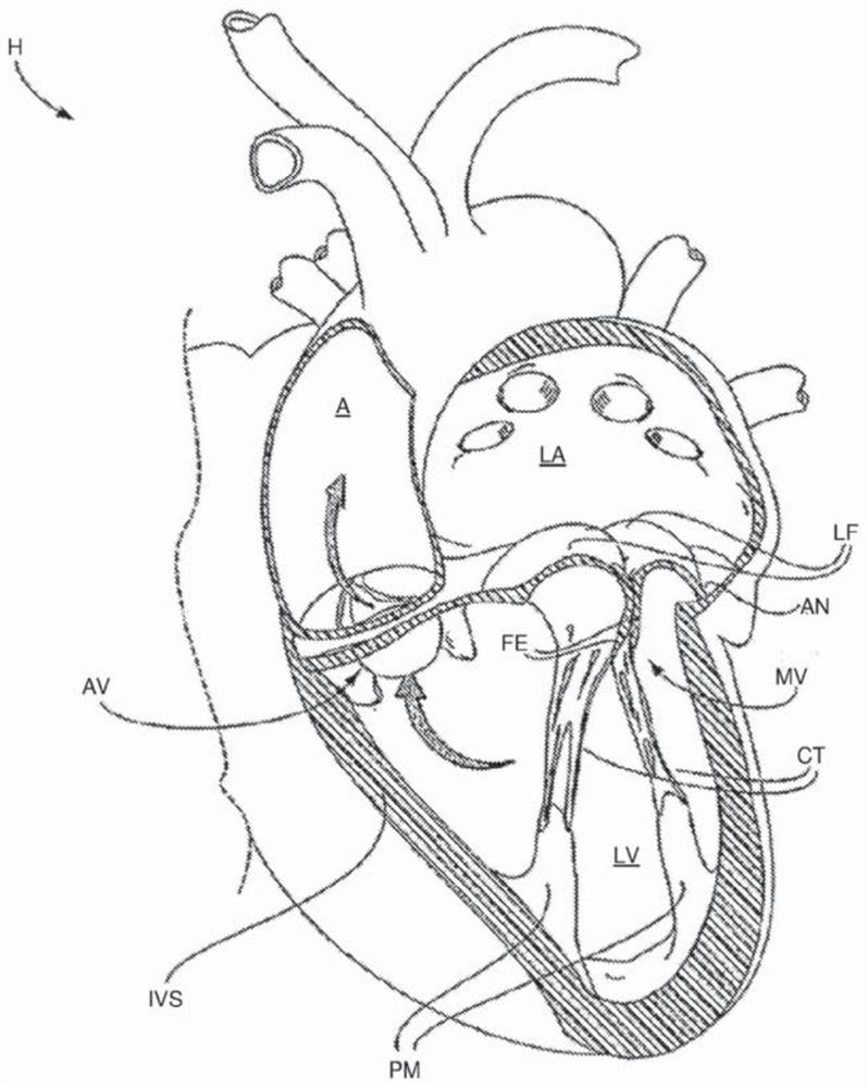 Tissue grasping device and related methods