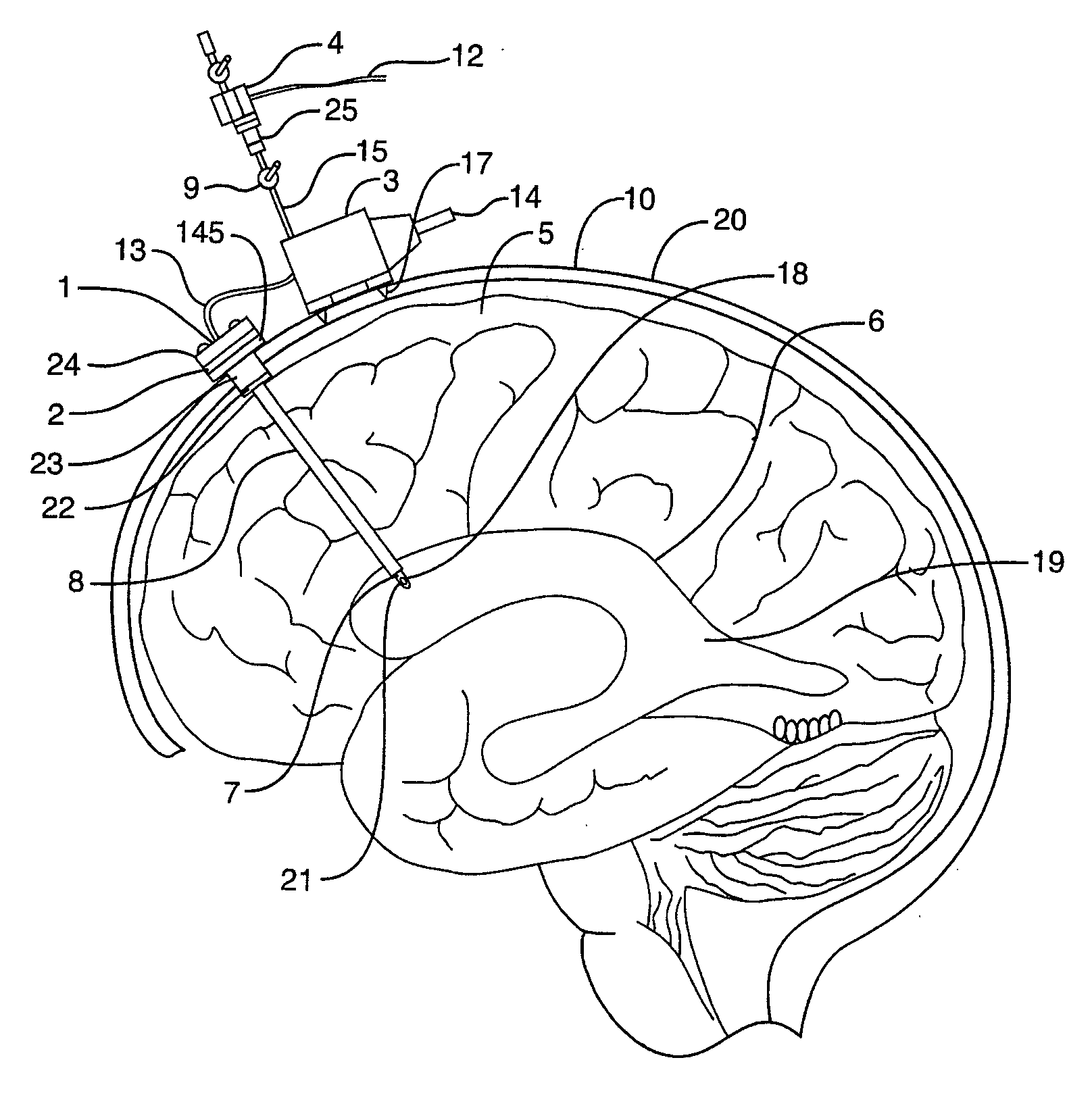 Method and device for reducing secondary brain injury