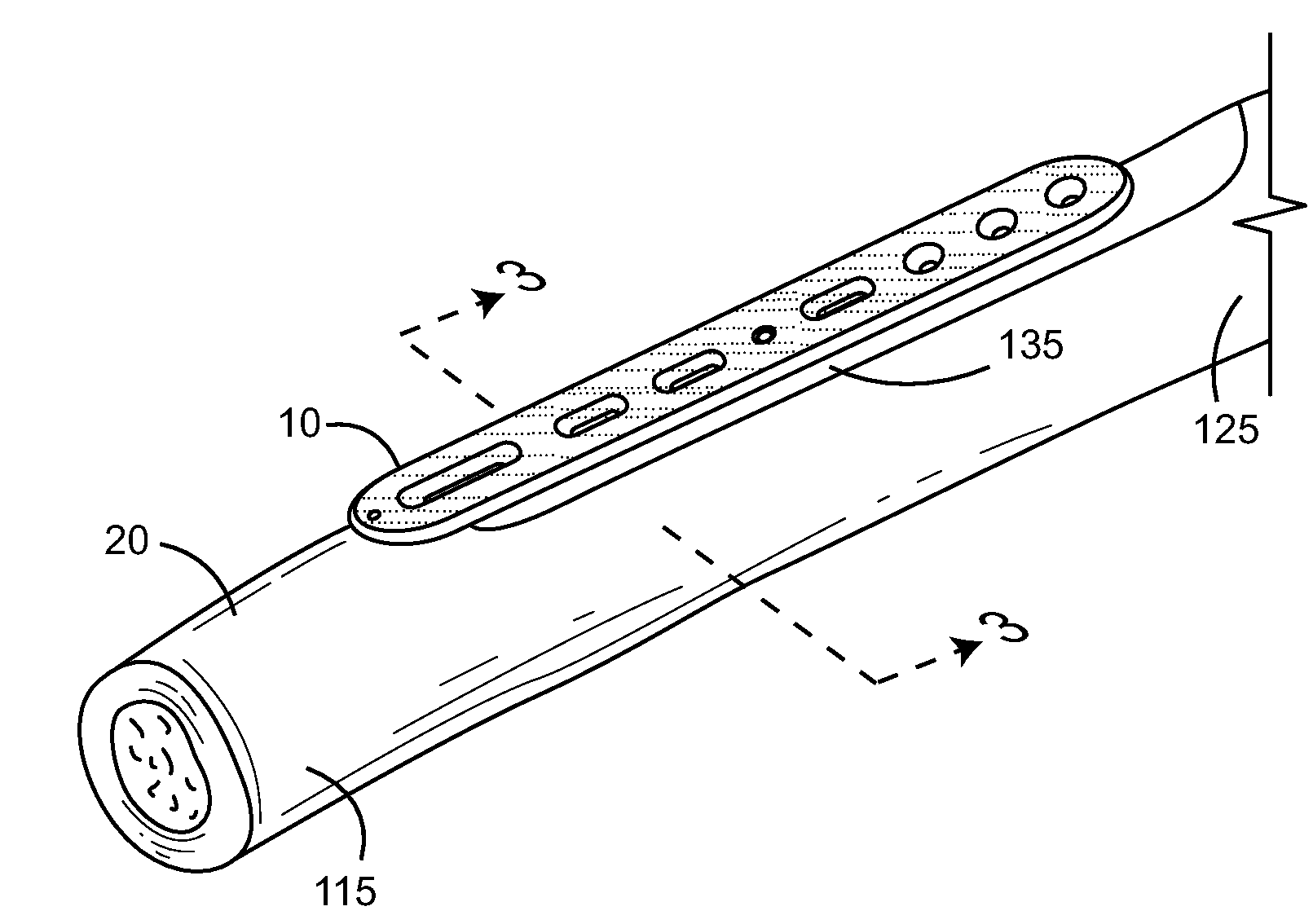 Ulnar osteotomy plate including increased compression