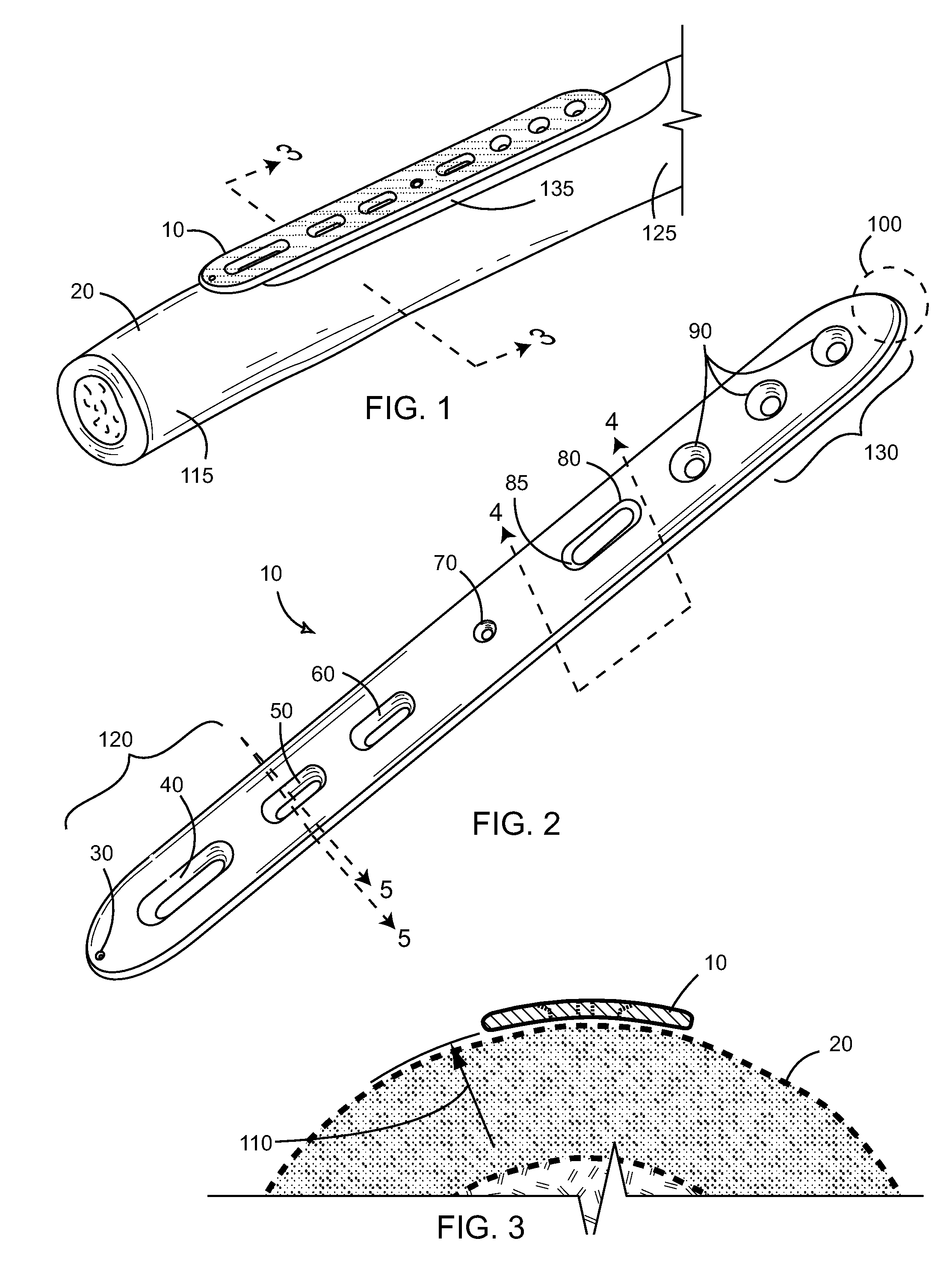 Ulnar osteotomy plate including increased compression