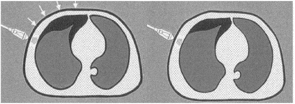 Device and method for automatic pneumothorax detection