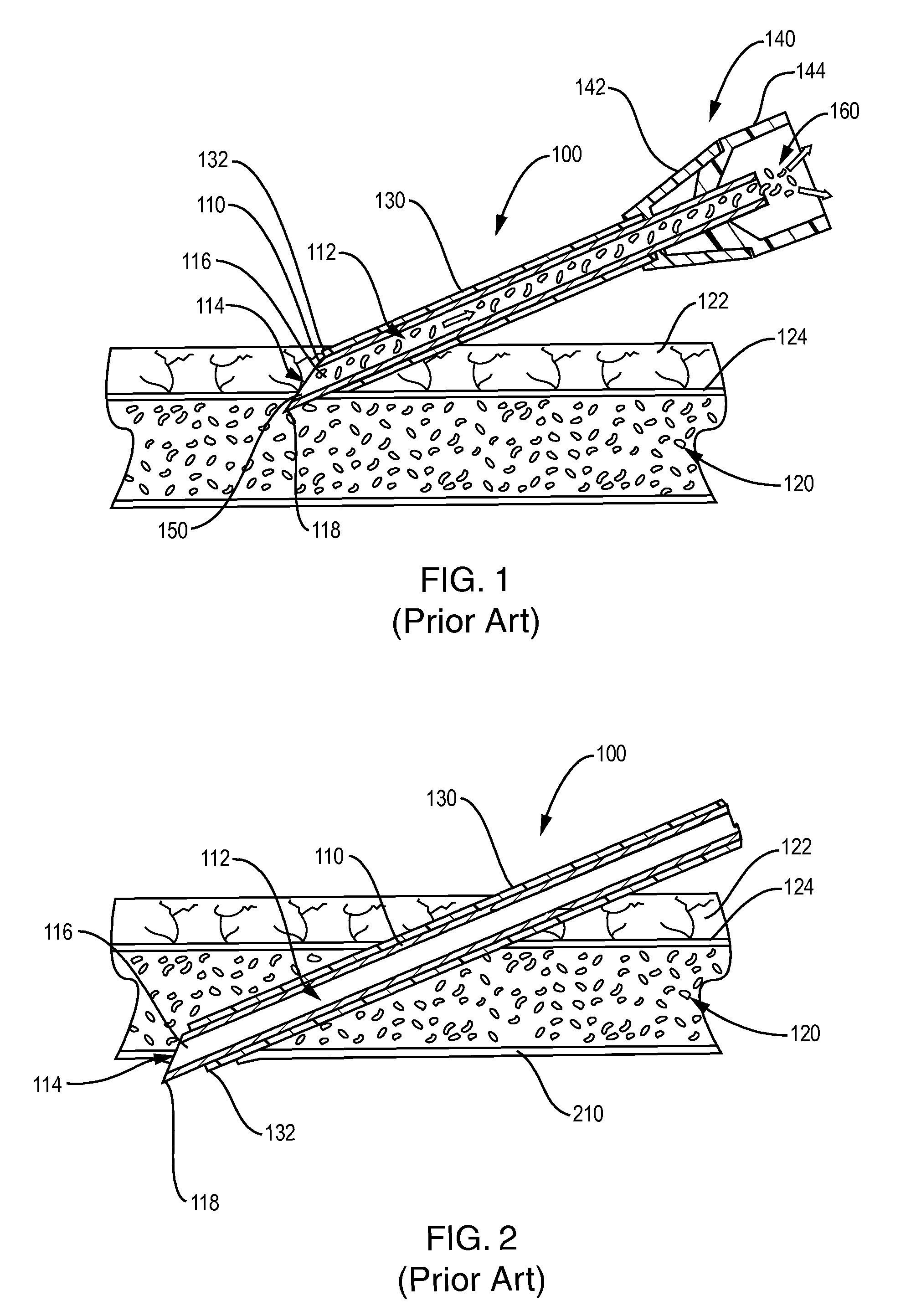 Intravascular needle and catheter assembly