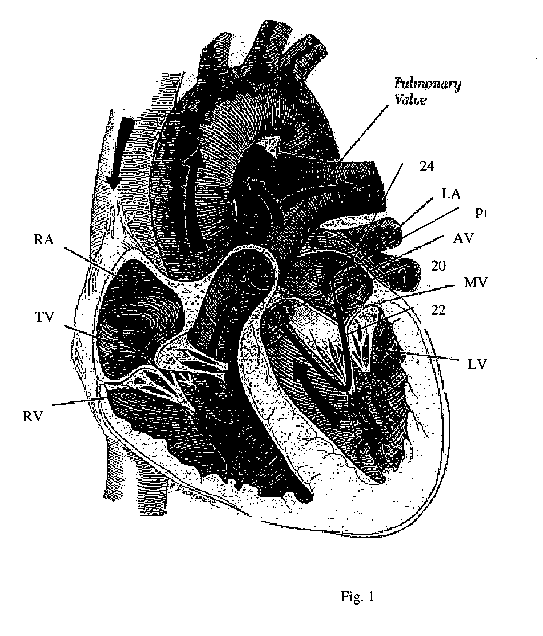 Navigation of remotely actuable medical device using control variable and length