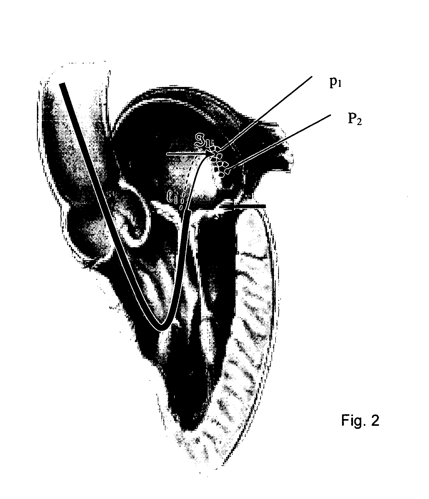 Navigation of remotely actuable medical device using control variable and length