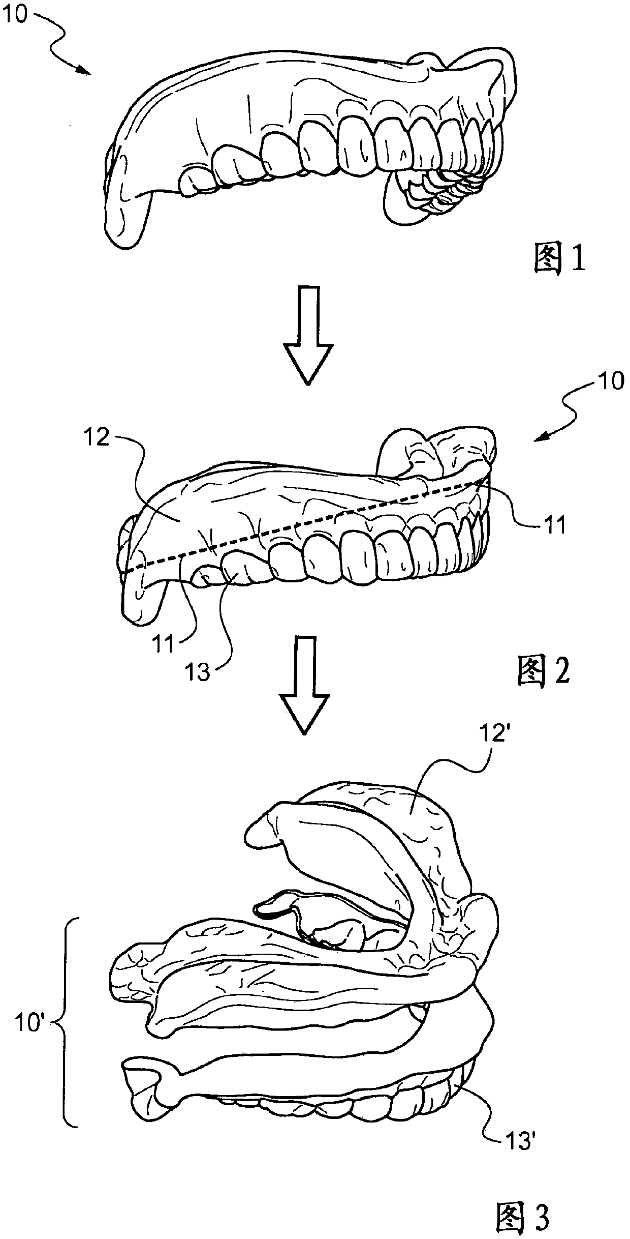 Method for manufacture of removable dental prosthesis by moulding with the aid of mould formed by additive manufacture