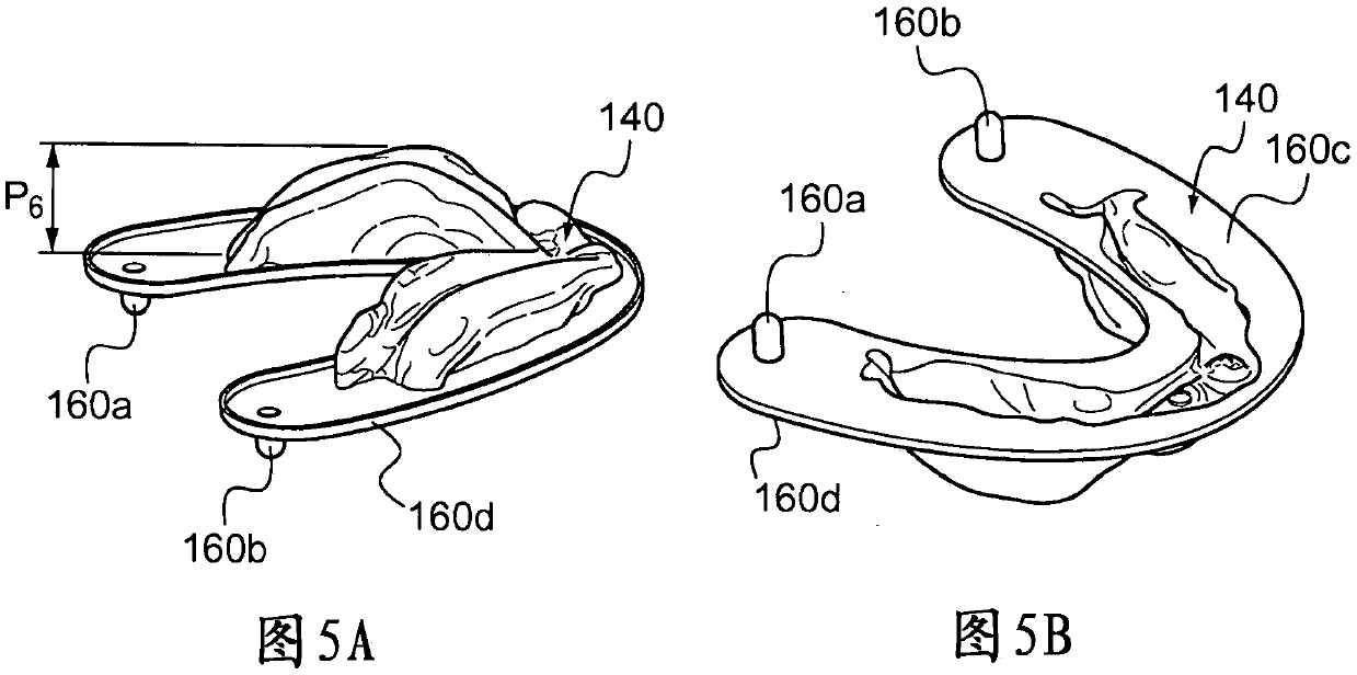 Method for manufacture of removable dental prosthesis by moulding with the aid of mould formed by additive manufacture