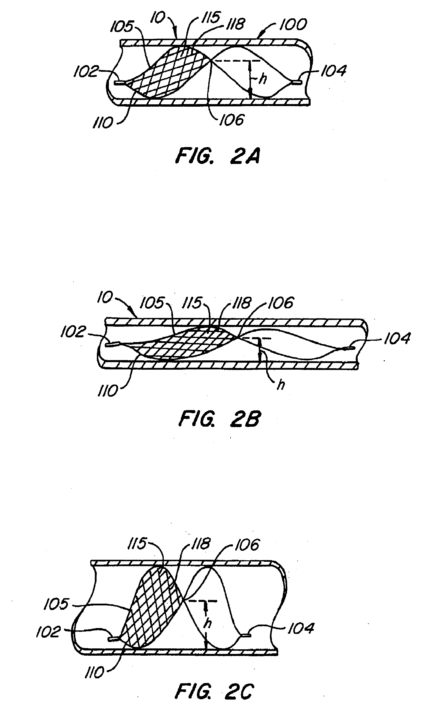 Endoluminal filter