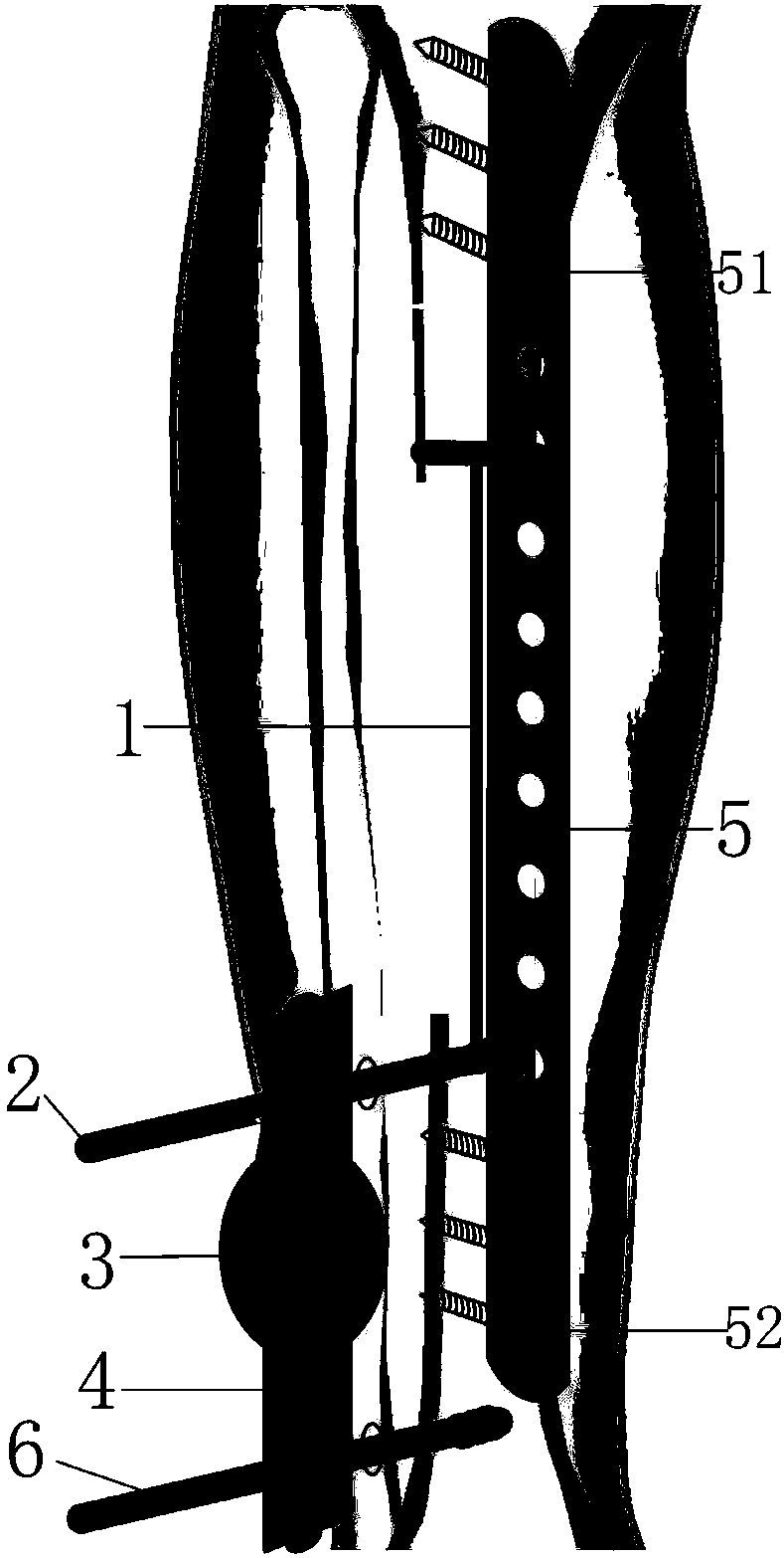 Transporting device for titanium cable traction bones and use method of transporting device