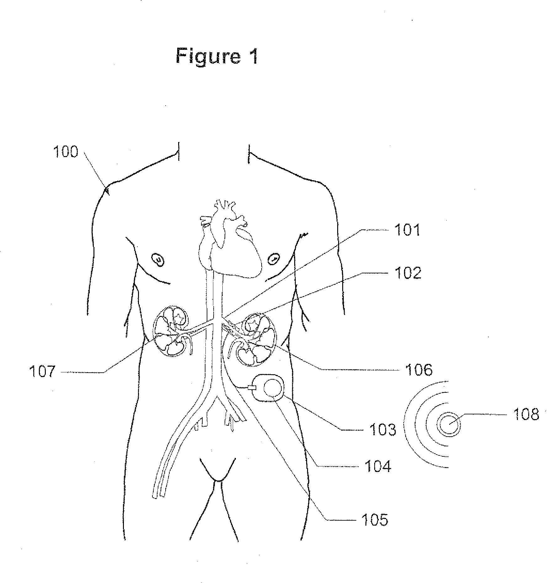 Method and apparatus for reducing renal blood pressure