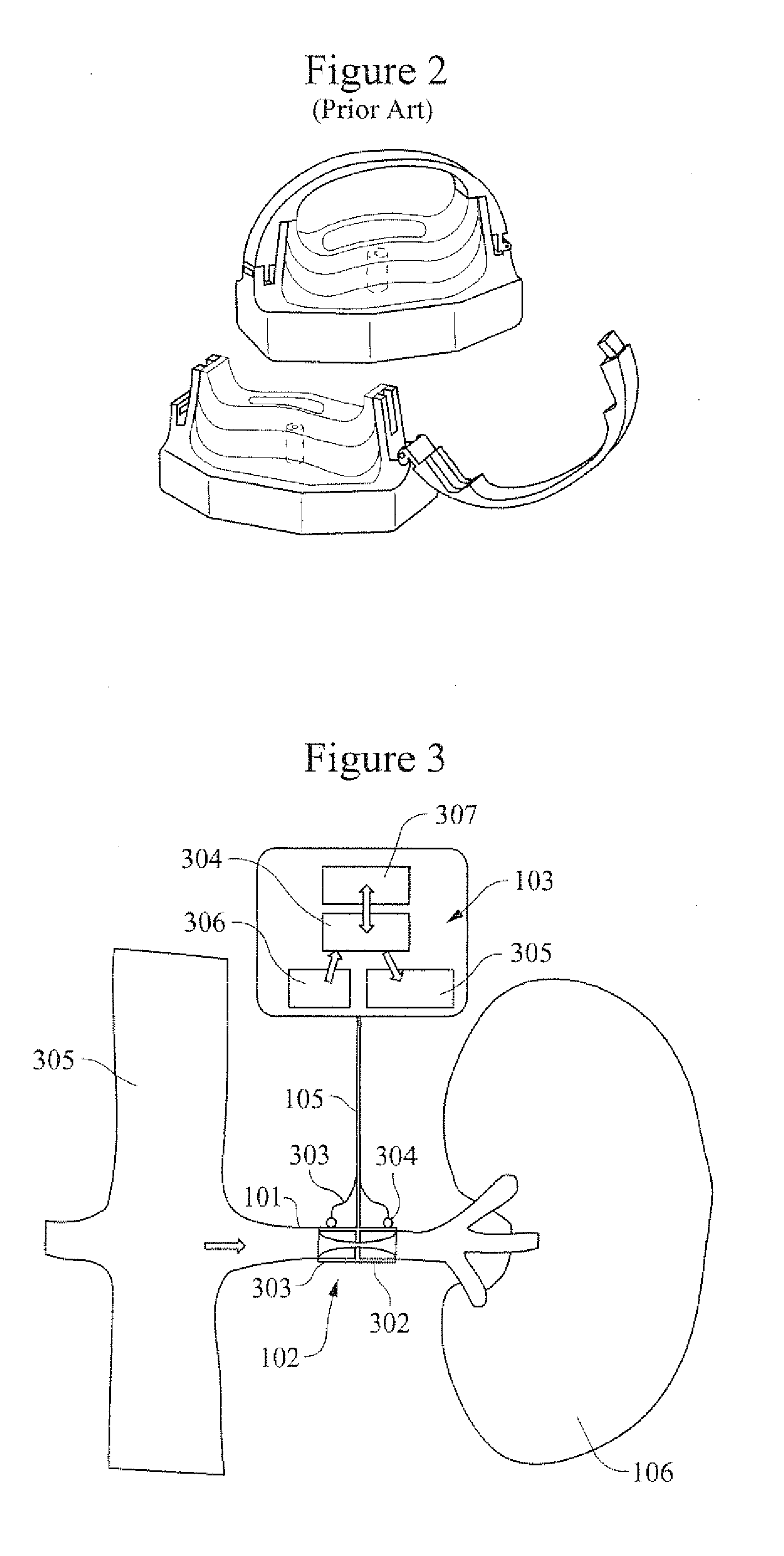 Method and apparatus for reducing renal blood pressure