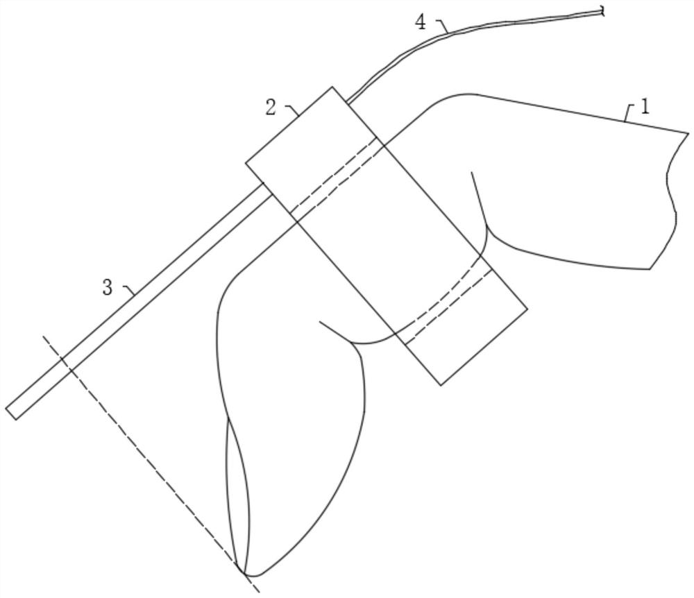 Finger-wearing type surgical instrument