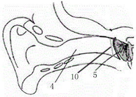 Tympanum puncture positioning device