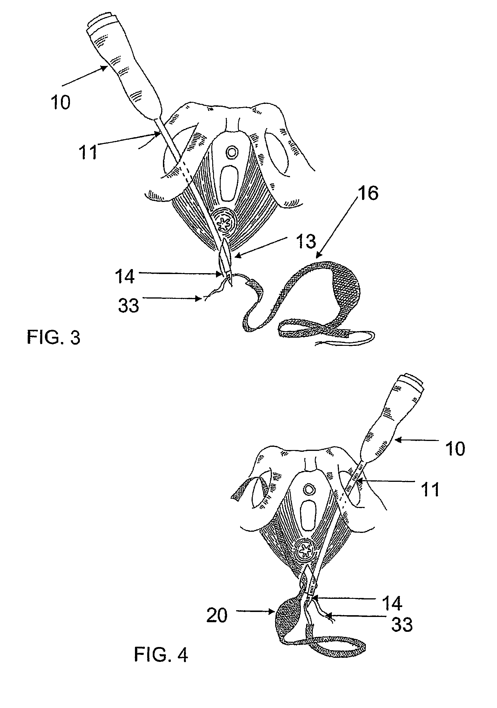 System and method for treatment of anal incontinence and pelvic organ prolapse