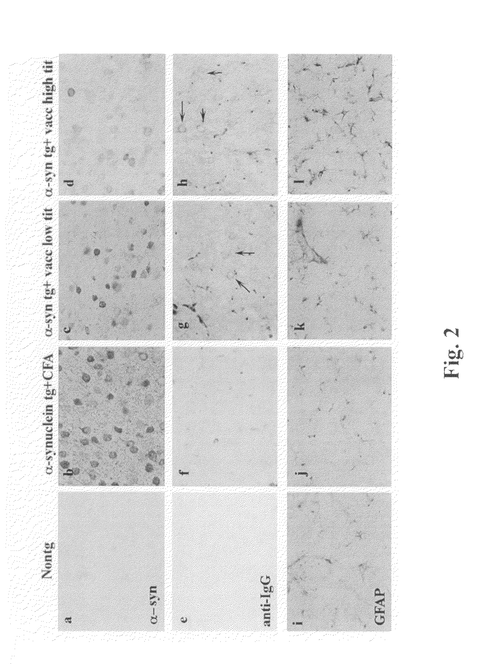 Treatment and delay of outset of synucleinopathic and amyloidogenic disease