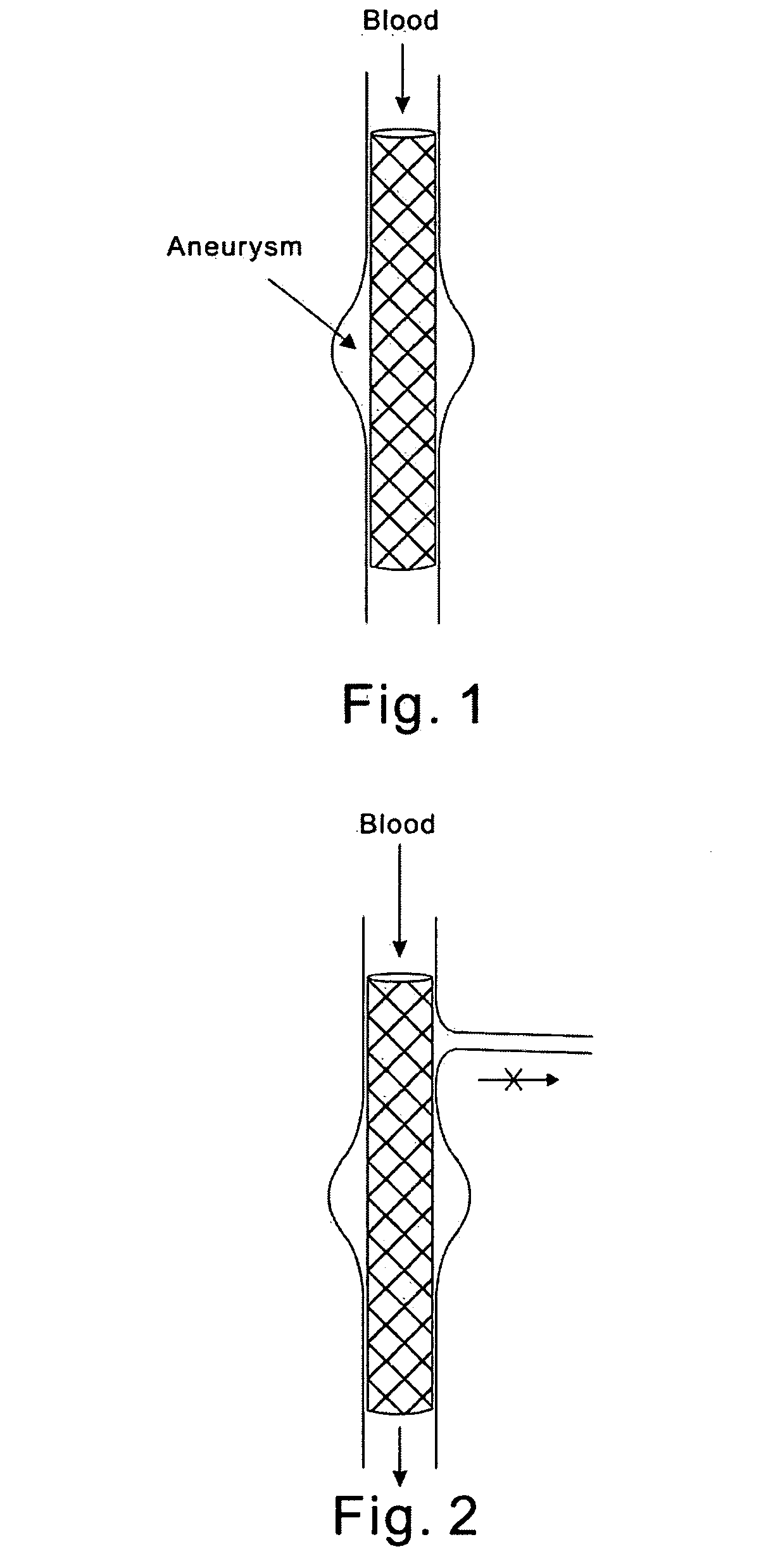 Modular stent graft and delivery system