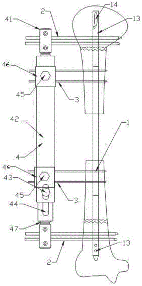 Bone transport apparatus for treatment of large segmental defect of humerus