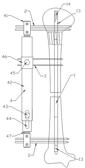 Bone transport apparatus for treatment of large segmental defect of humerus