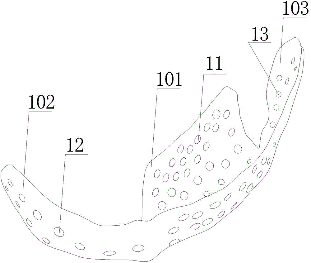 String bag type lower jawbone implant applying three-dimensional printing technology