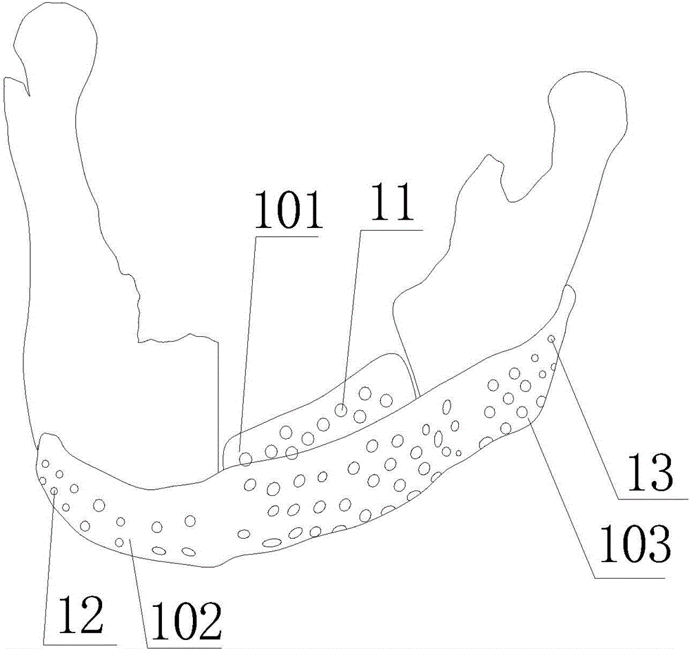 String bag type lower jawbone implant applying three-dimensional printing technology