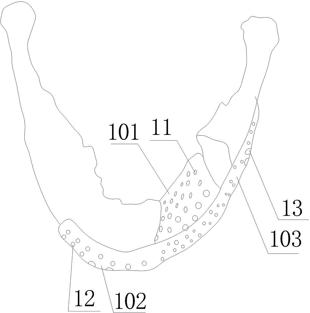 String bag type lower jawbone implant applying three-dimensional printing technology