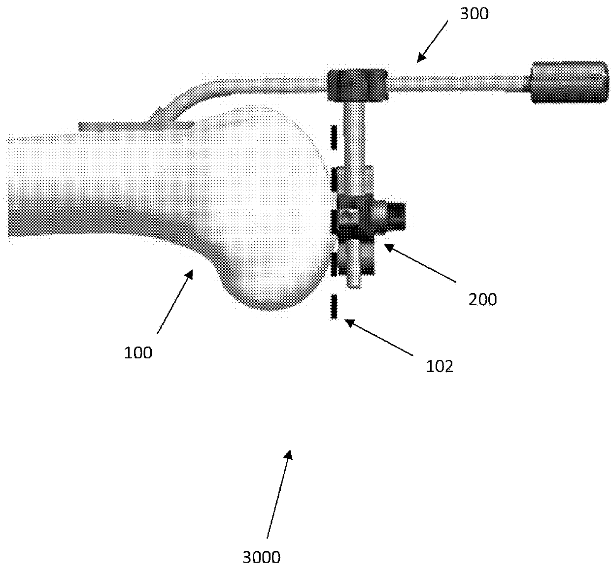 Anatomically guided instrumentation for trochlear groove replacement