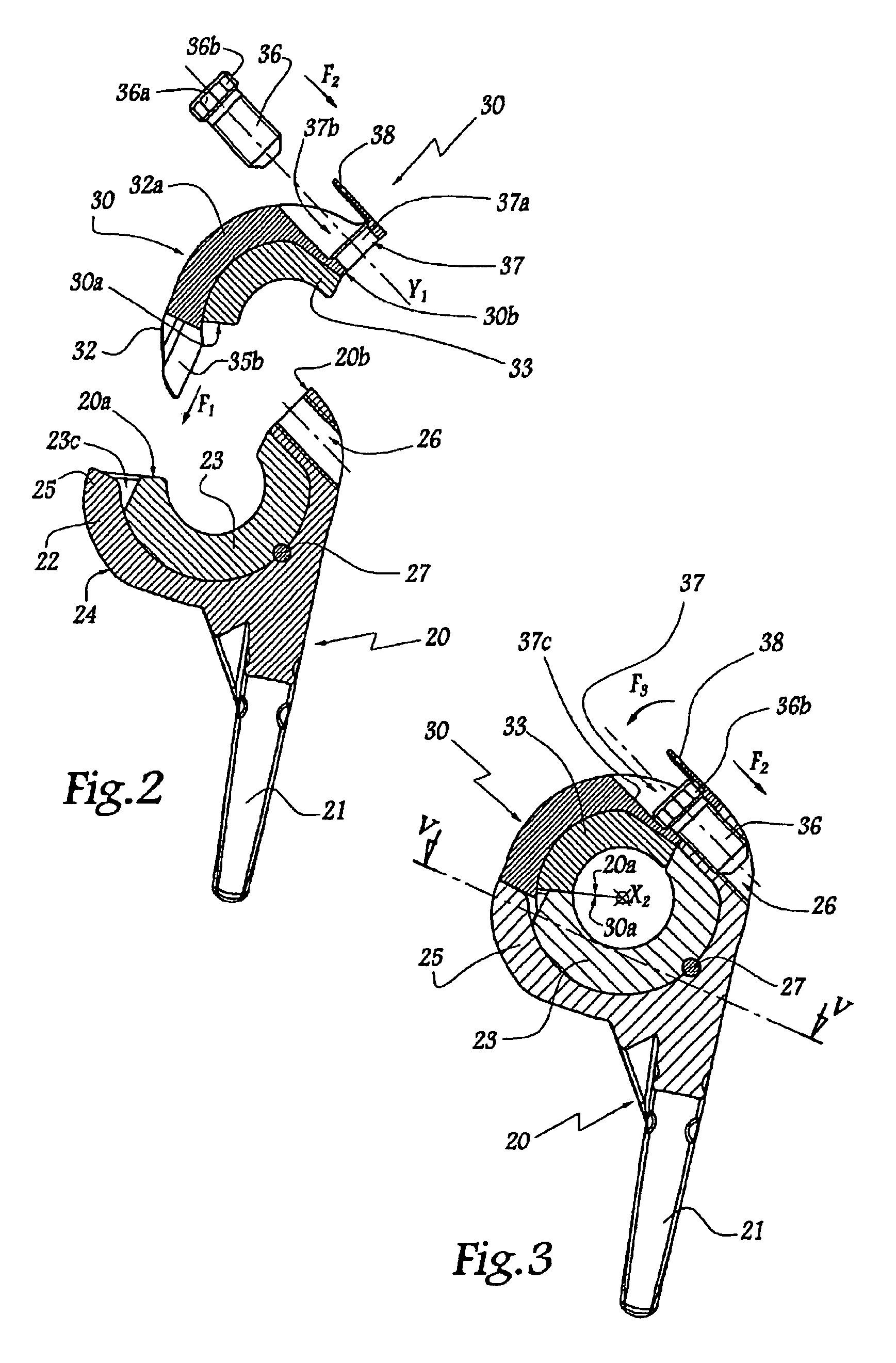 Elbow prosthesis