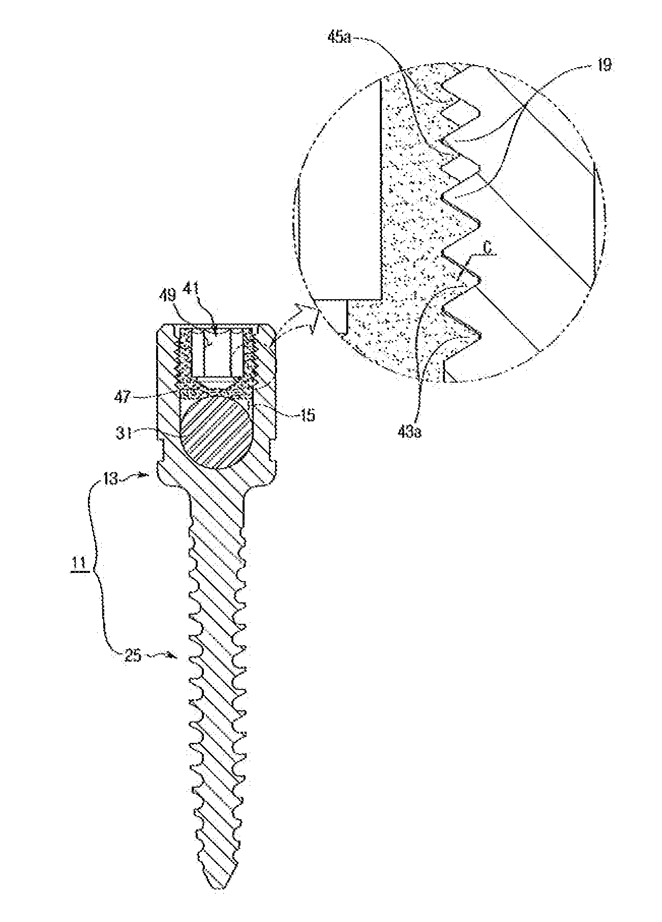 Spine Fixation Device Containing Set Screw Having Double Spiral Form