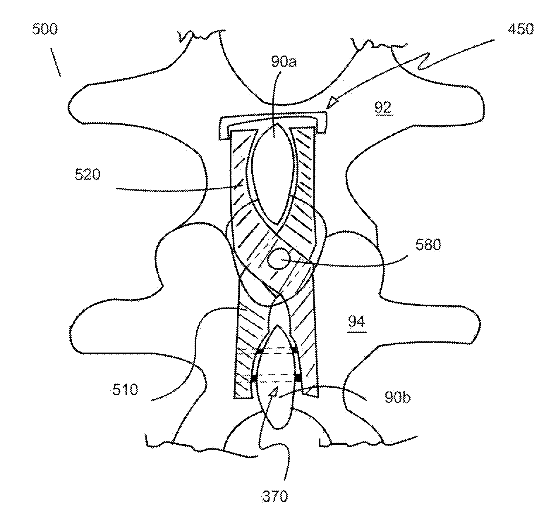 Spinous process fixation implant