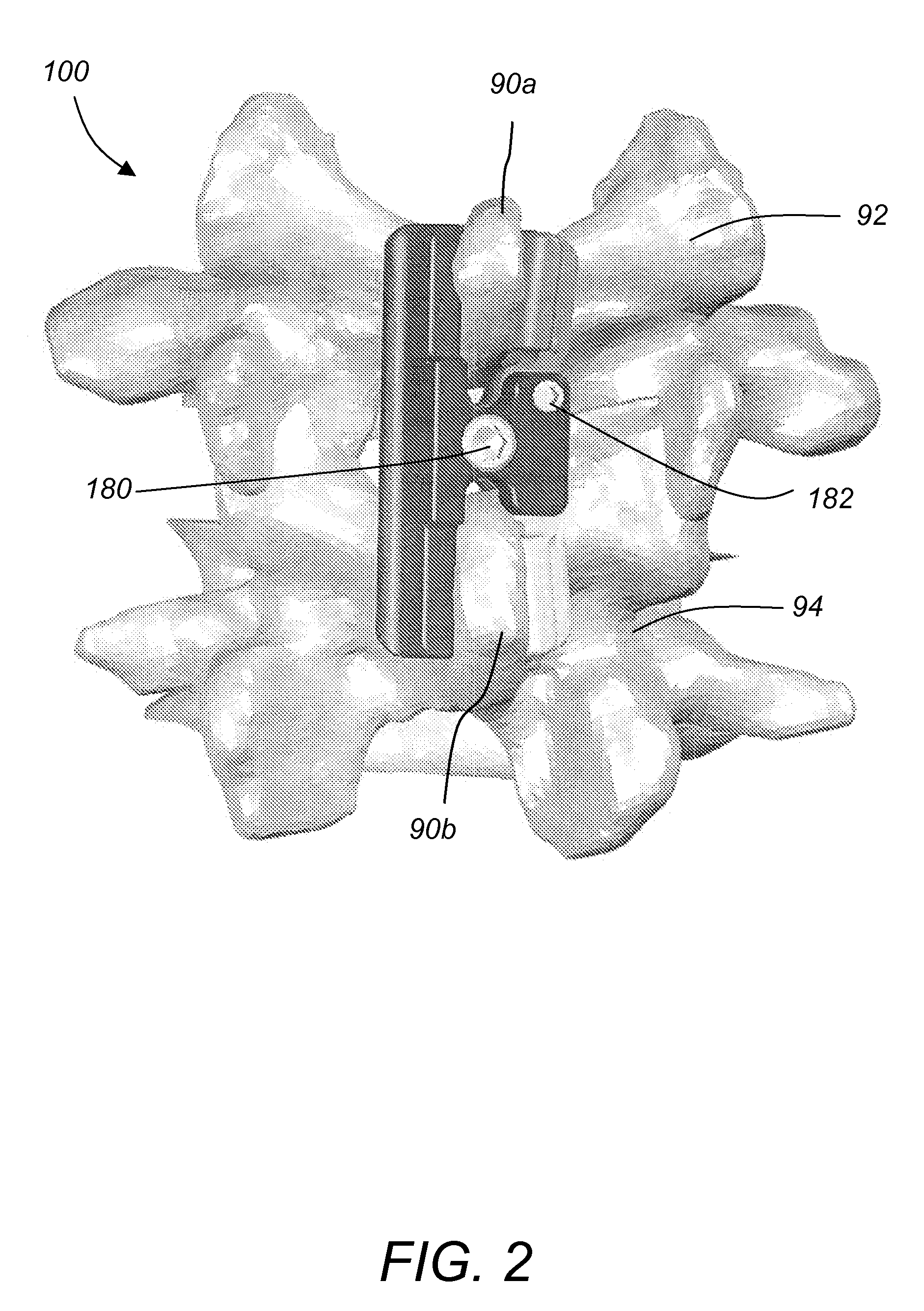 Spinous process fixation implant