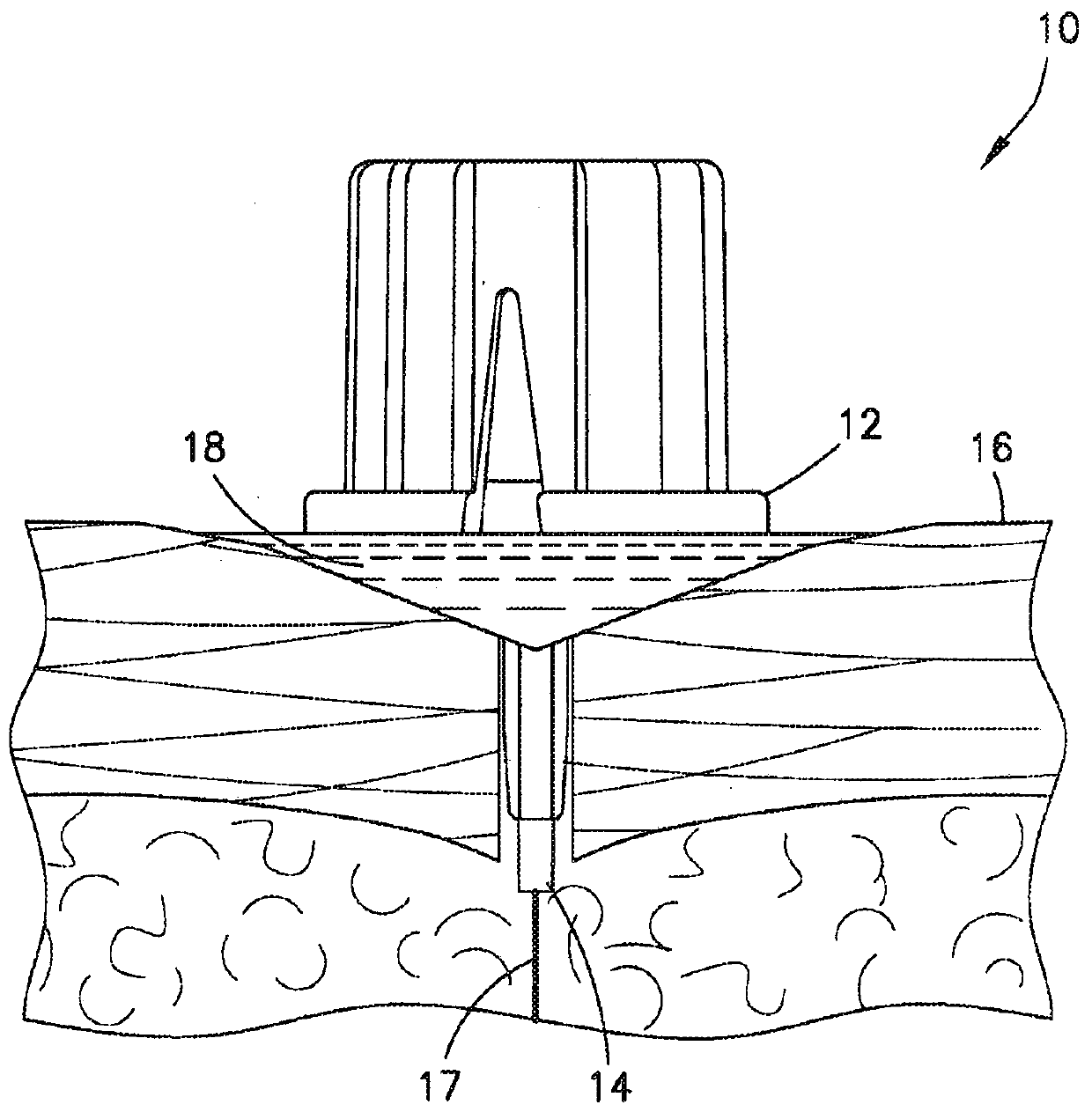 Insulin leakage sensor with electric control to stop insulin flow